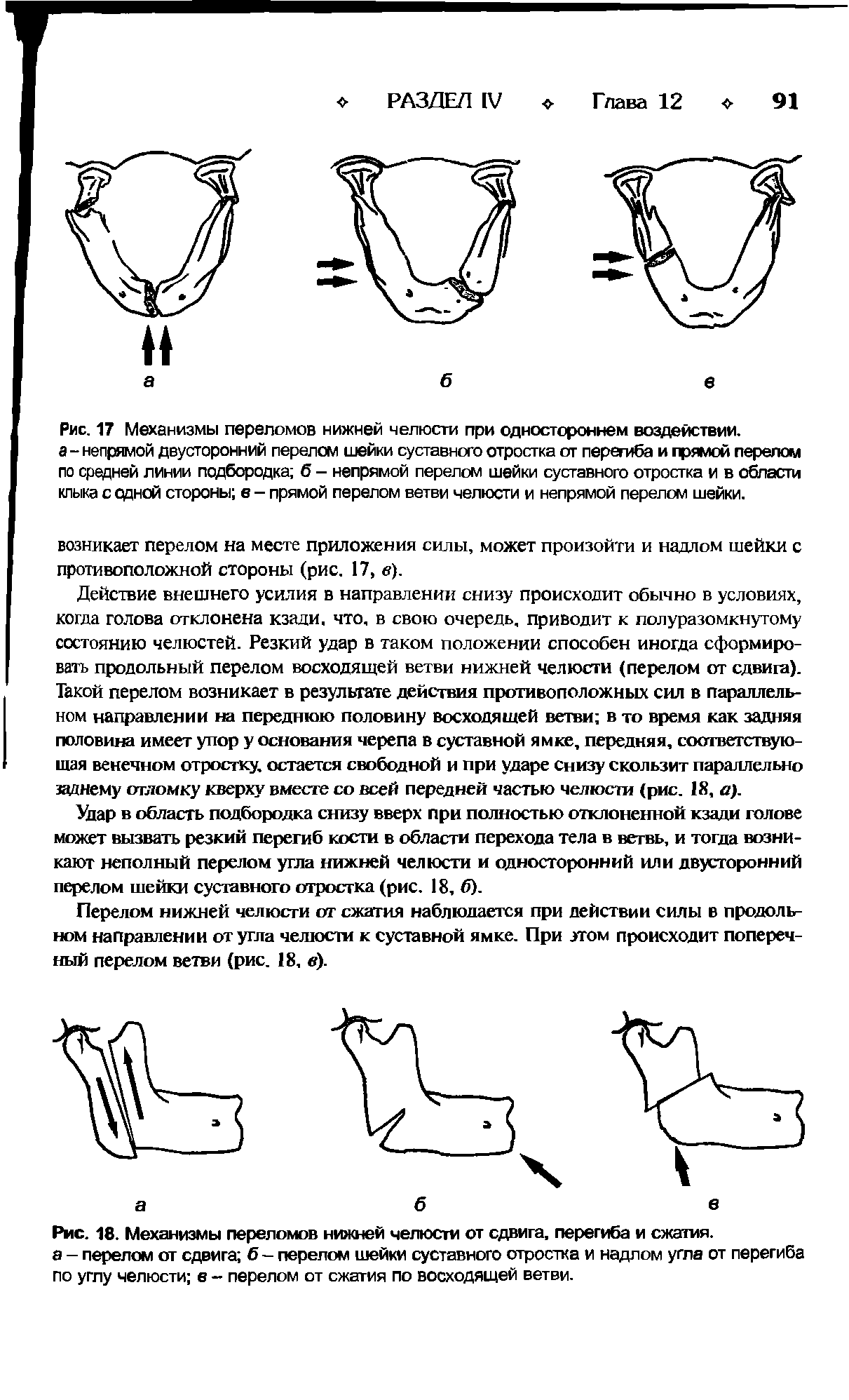 Рис. 18. Механизмы переломов нижней челюсти от сдвига, перегиба и сжатия.