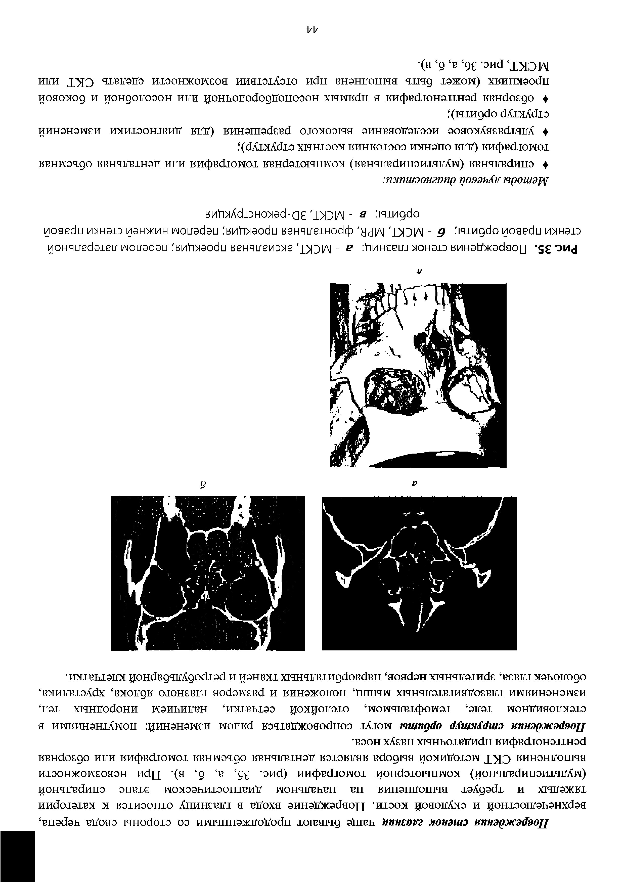 Рис. 35. Повреждения стенок глазниц а - МСКТ, аксиальная проекция перелом латеральной стенки правой орбиты б - МСКТ, МР(< фронтальная проекция перелом нижней стенки правой орбиты в - МСКТ, ЗО-реконструкция...