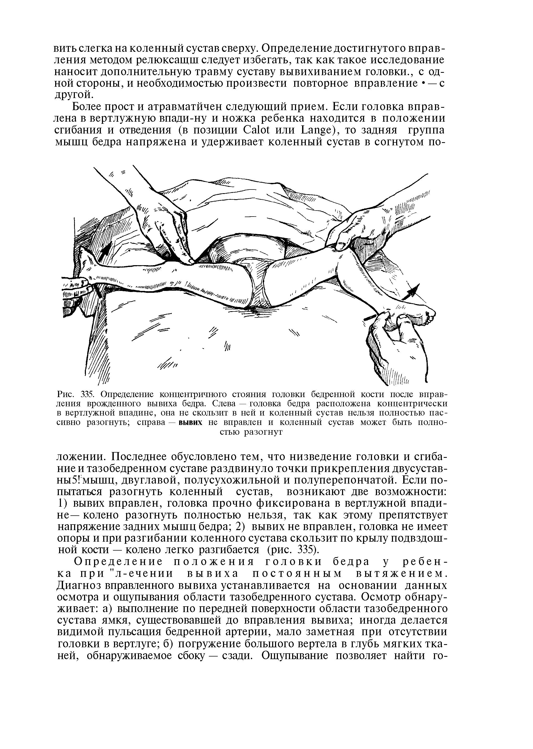 Рис. 335. Определение концентричного стояния головки бедренной кости после вправления врожденного вывиха бедра. Слева — головка бедра расположена концентрически в вертлужной впадине, она не скользит в ней и коленный сустав нельзя полностью пассивно разогнуть справа — вывих не вправлен и коленный сустав может быть полно-...