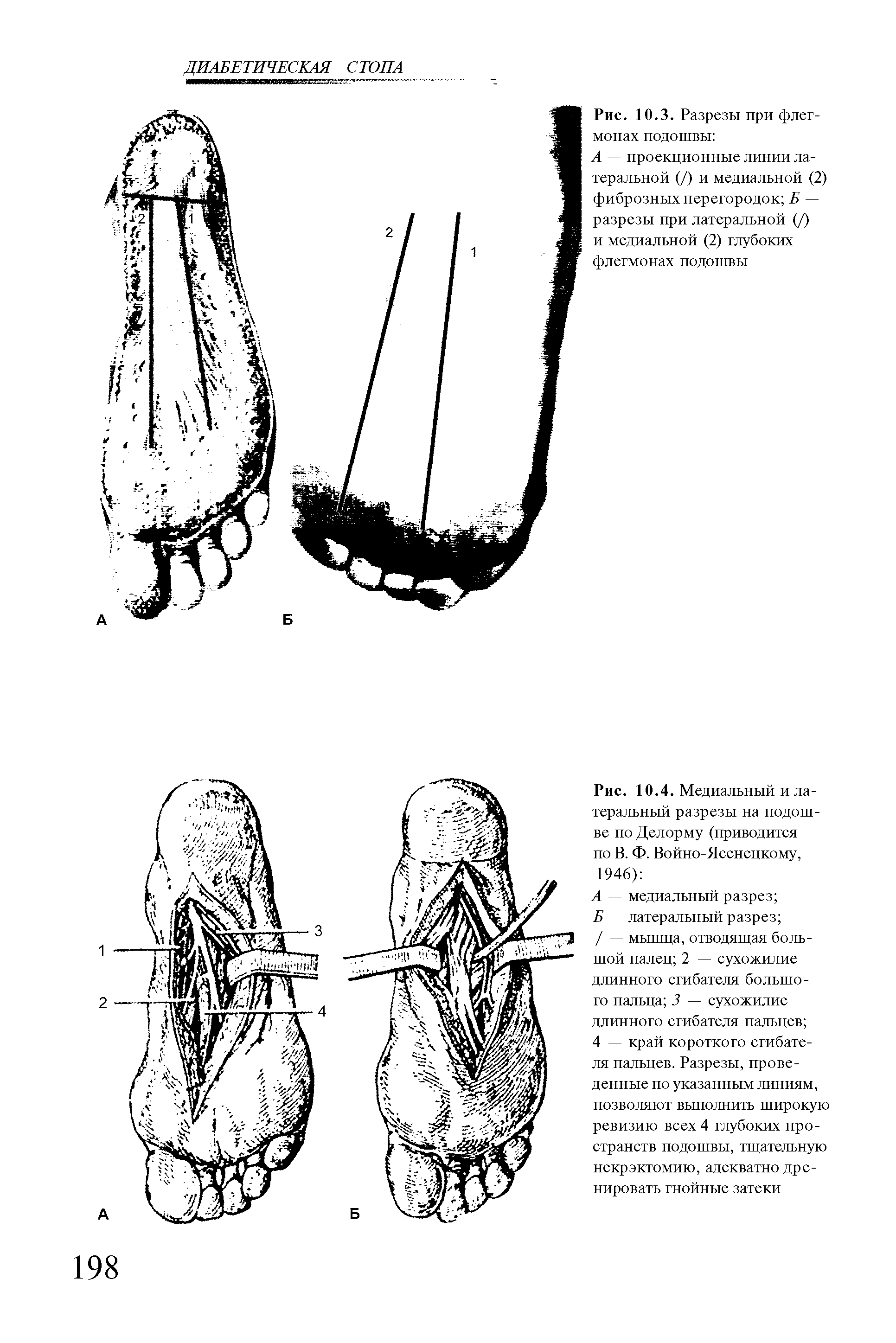Рис. 10.4. Медиальный и латеральный разрезы на подошве по Делорму (приводится по В. Ф. Войно-Ясенецкому, 1946) ...
