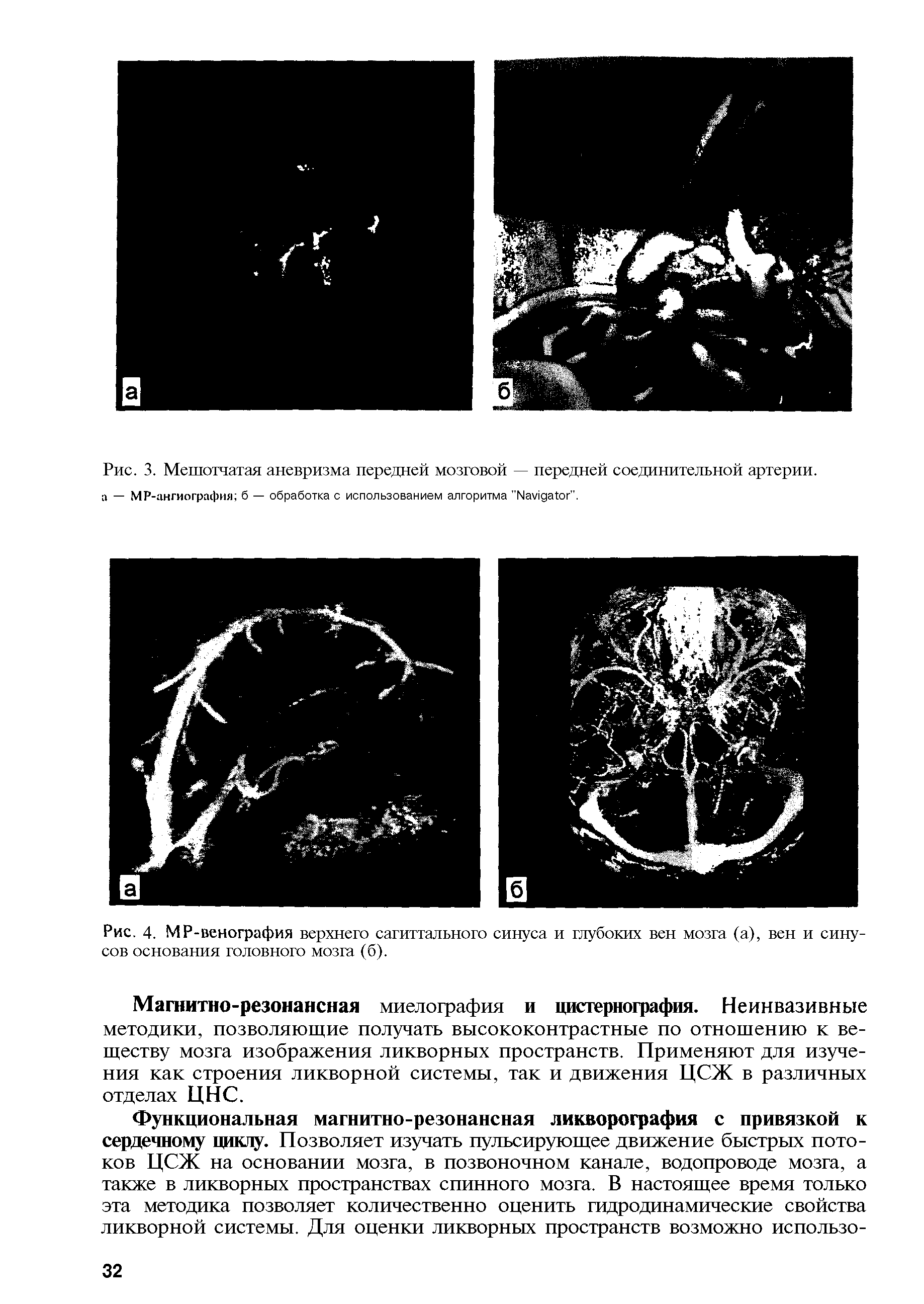 Рис. 4. МР-венография верхнего сагиттального синуса и глубоких вен мозга (а), вен и синусов основания головного мозга (б).