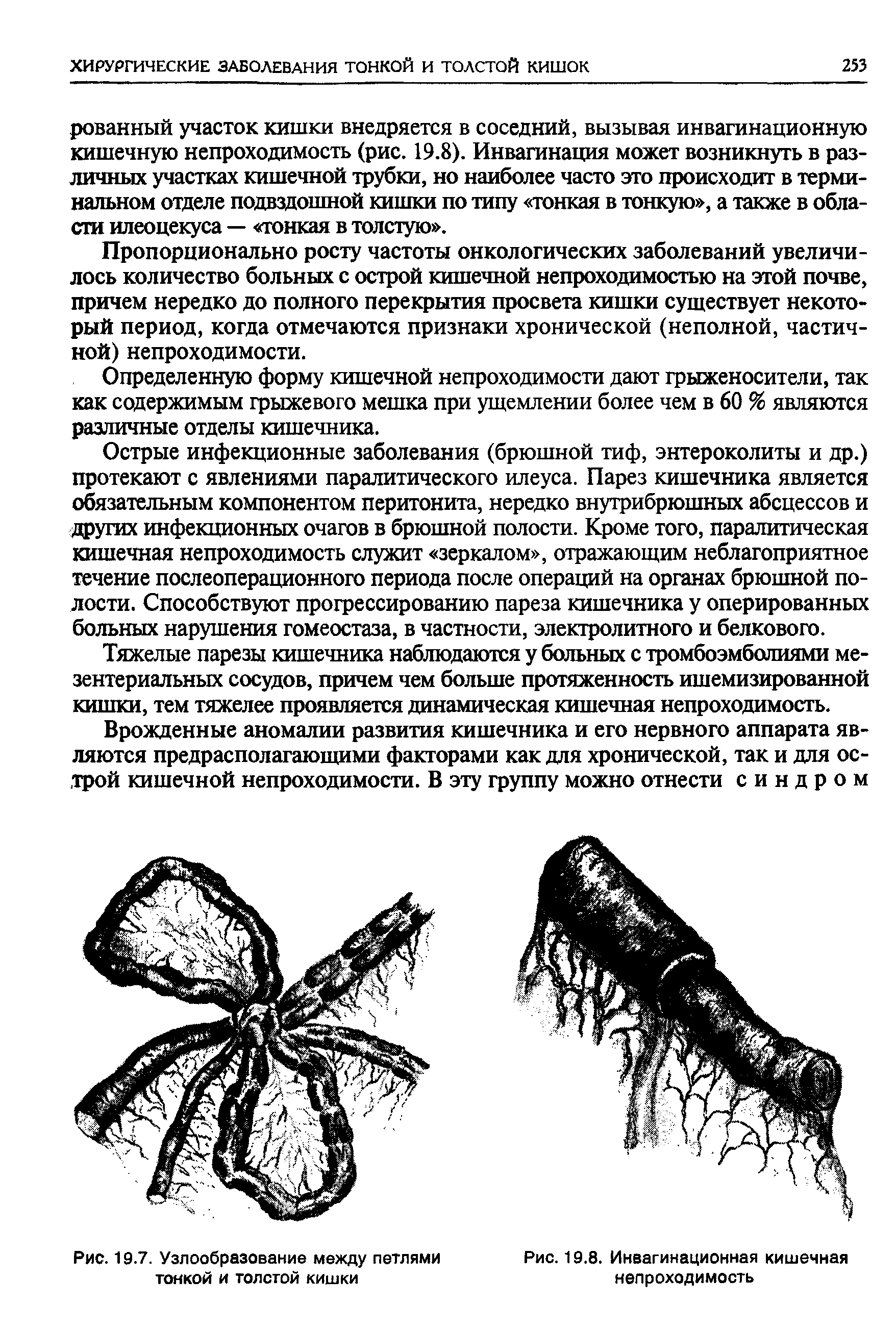 Рис. 19.7. Узлообразование между петлями тонкой и толстой кишки...