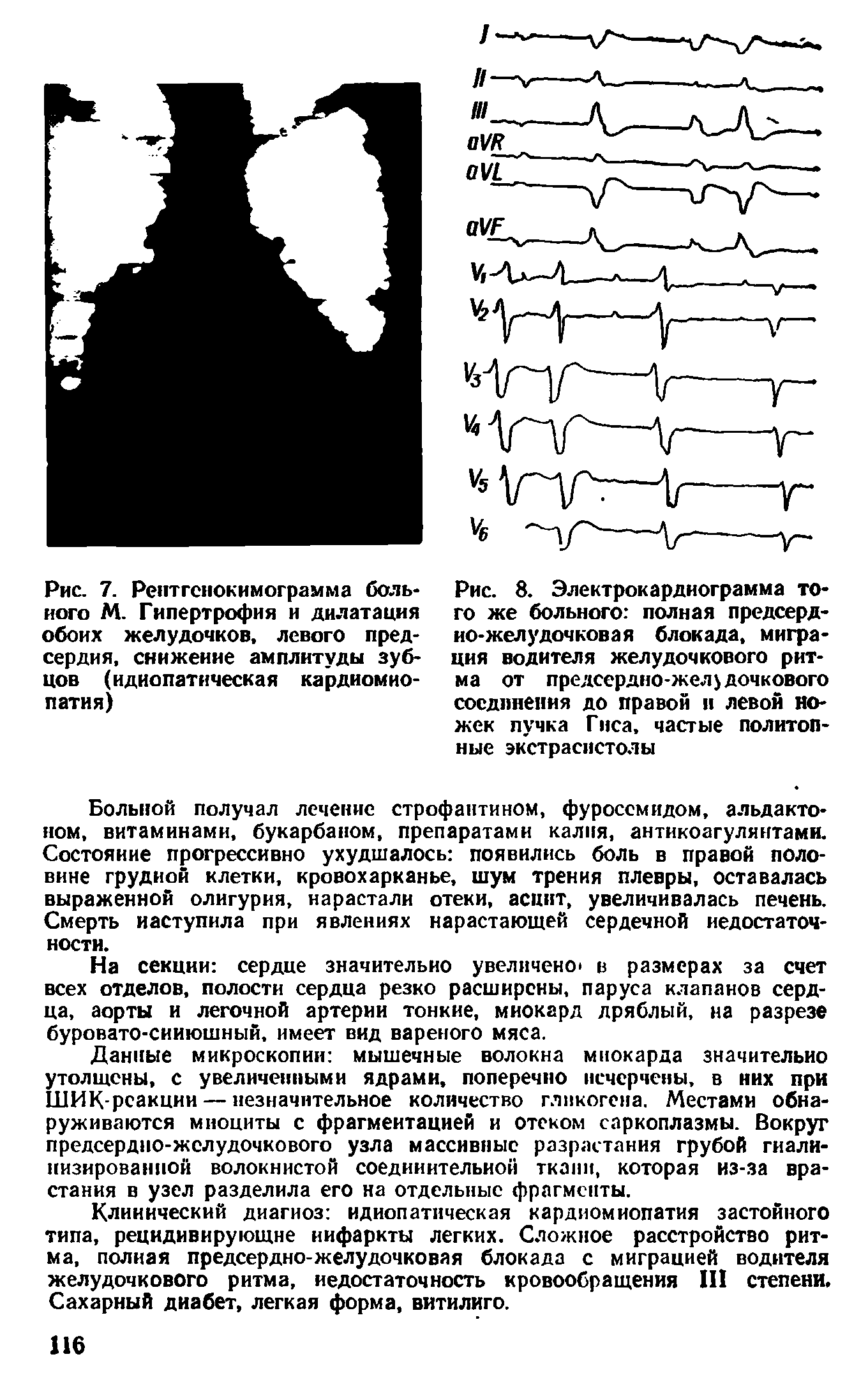 Рис. 8. Электрокардиограмма того же больного полная предсердно-желудочковая блокада, миграция водителя желудочкового ритма от предсердно-желудочкового соединения до правой и левой ножек пучка Гиса, частые политоп-ные экстрасистолы...