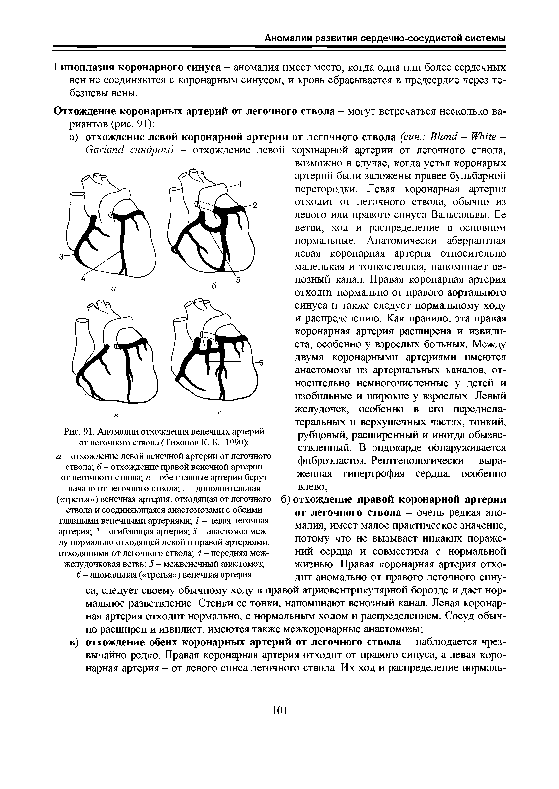 Рис. 91. Аномалии отхождения венечных артерий от легочного ствола (Тихонов К. Б., 1990) ...