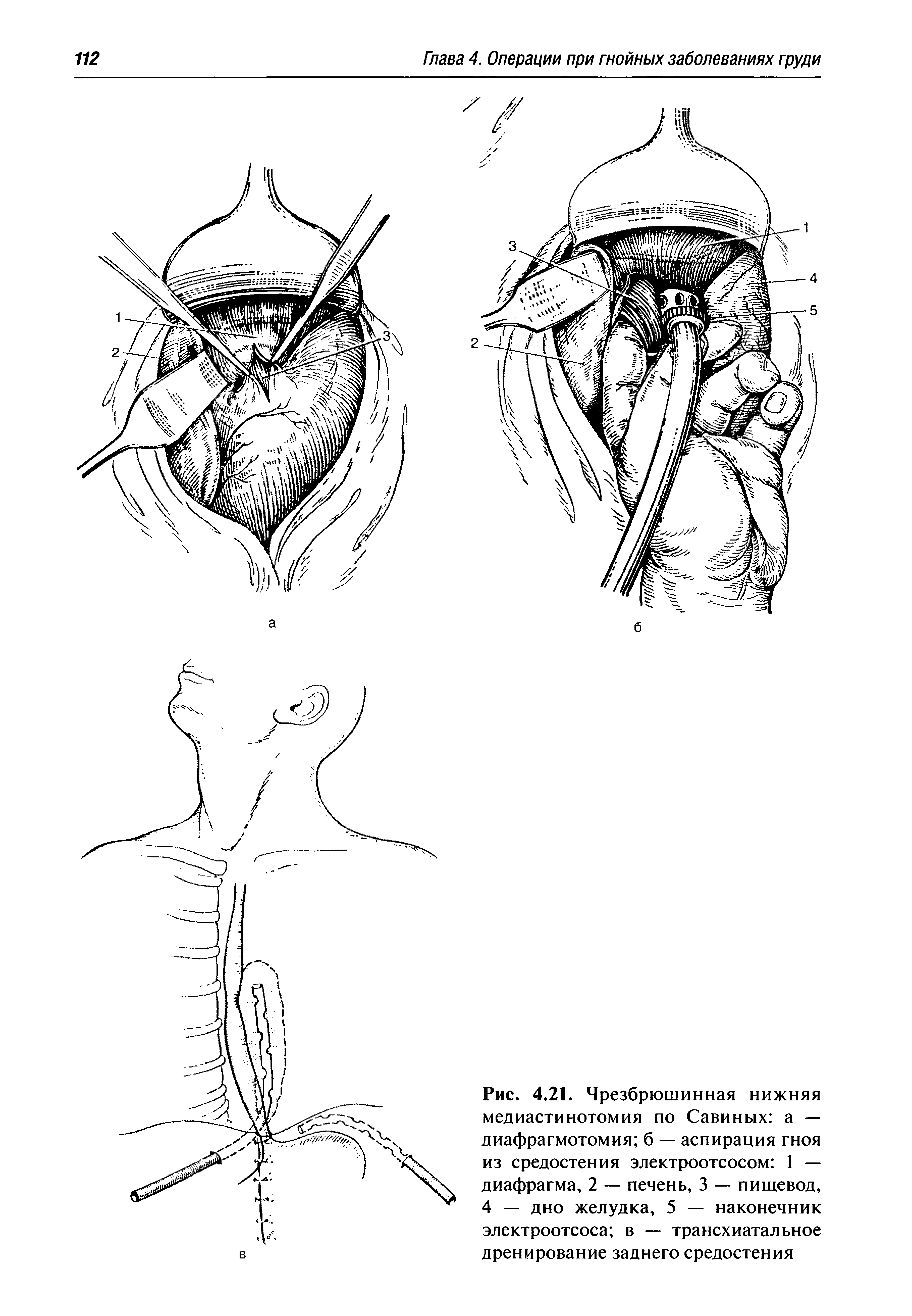 Рис. 4.21. Чрезбрюшинная нижняя медиастинотомия по Савиных а — диафрагмотомия б — аспирация гноя из средостения электроотсосом 1 — диафрагма, 2 — печень, 3 — пищевод, 4 — дно желудка, 5 — наконечник электроотсоса в — трансхиатальное дренирование заднего средостения...
