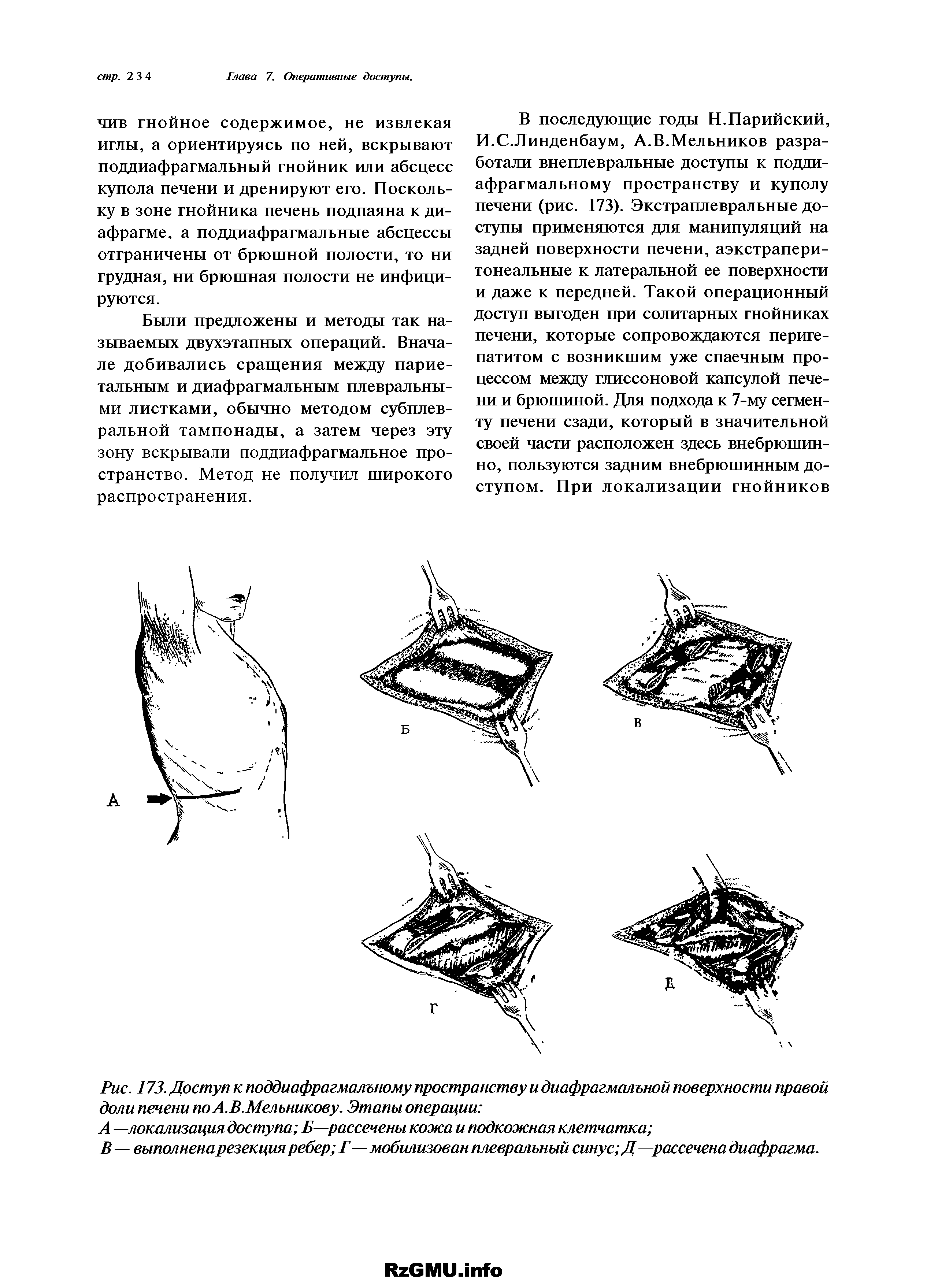 Рис. 173. Доступ к поддиафрагмалъному пространству и диафрагмальной поверхности правой доли печени по А. В. Мельникову. Этапы операции ...