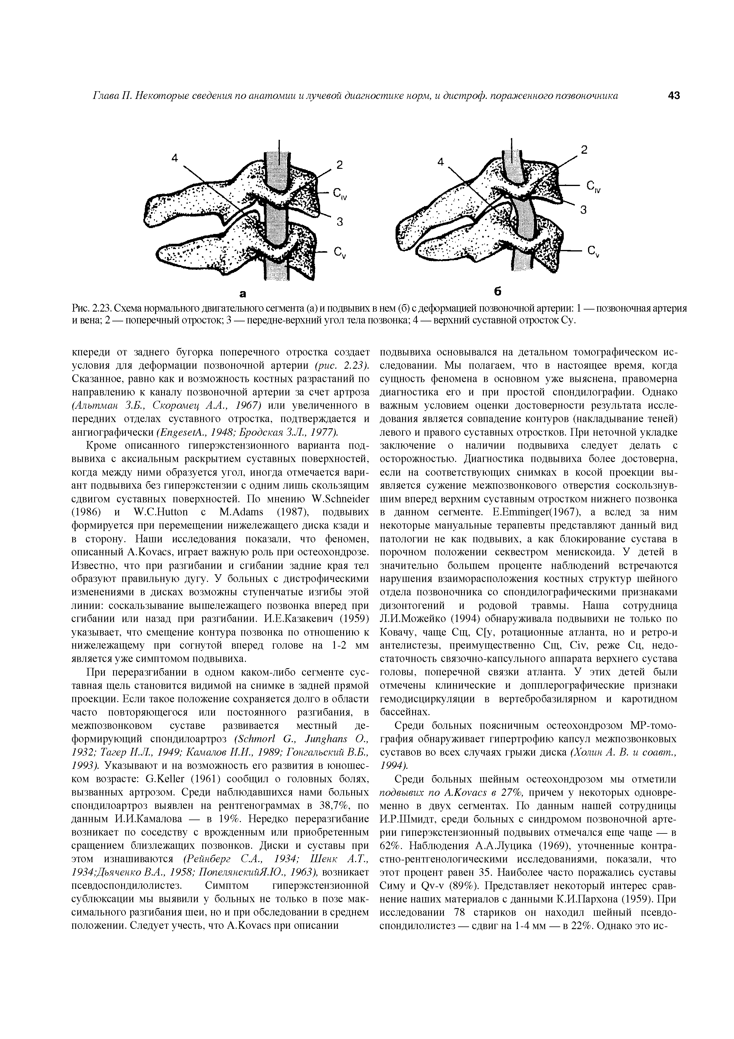 Рис. 2.23. Схема нормального двигательного сегмента (а) и подвывих в нем (б) с деформацией позвоночной артерии 1 — позвоночная артерия и вена 2 — поперечный отросток 3 — передне-верхний угол тела позвонка 4 — верхний суставной отросток Су.