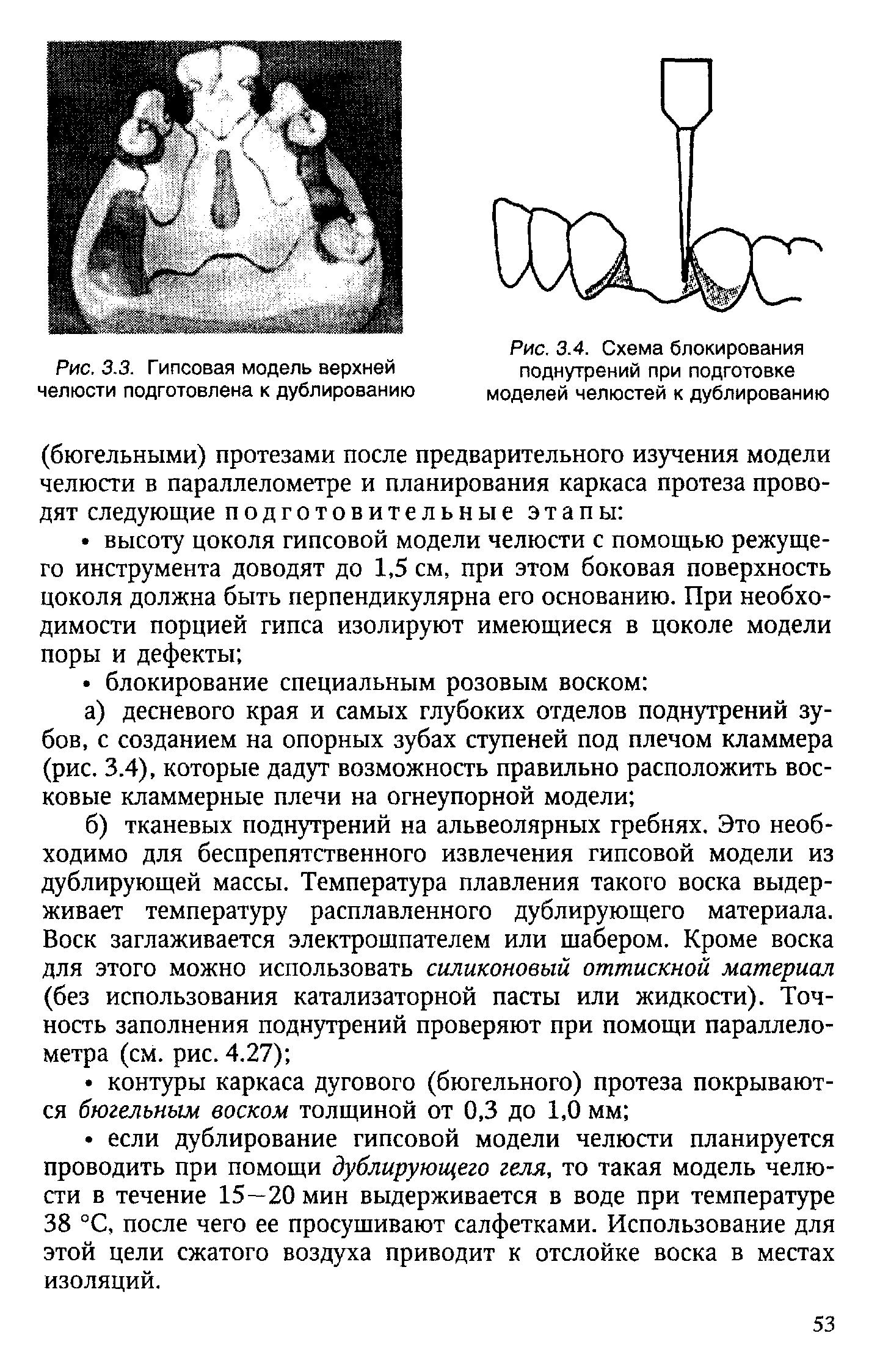 Рис. 3.4. Схема блокирования поднутрений при подготовке моделей челюстей к дублированию...