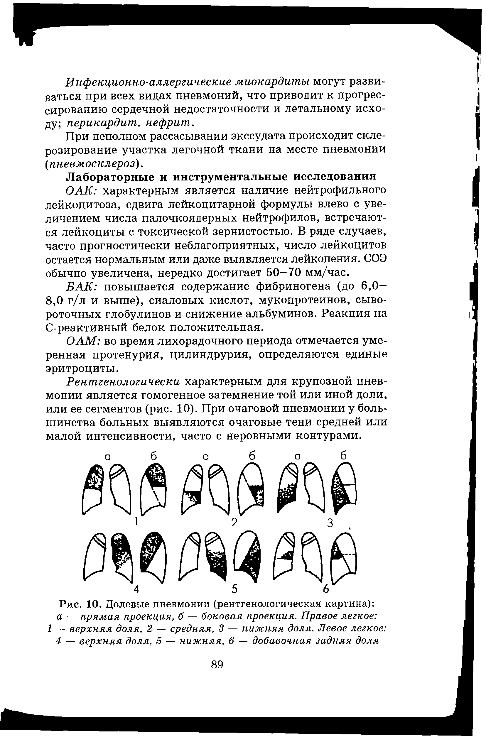 Рис. 10. Долевые пневмонии (рентгенологическая картина) а — прямая проекция, б — боковая проекция. Правое легкое 1 — верхняя доля, 2 — средняя, 3 — нижняя доля. Левое легкое 4 — верхняя доля, 5 — нижняя, 6 — добавочная задняя доля...