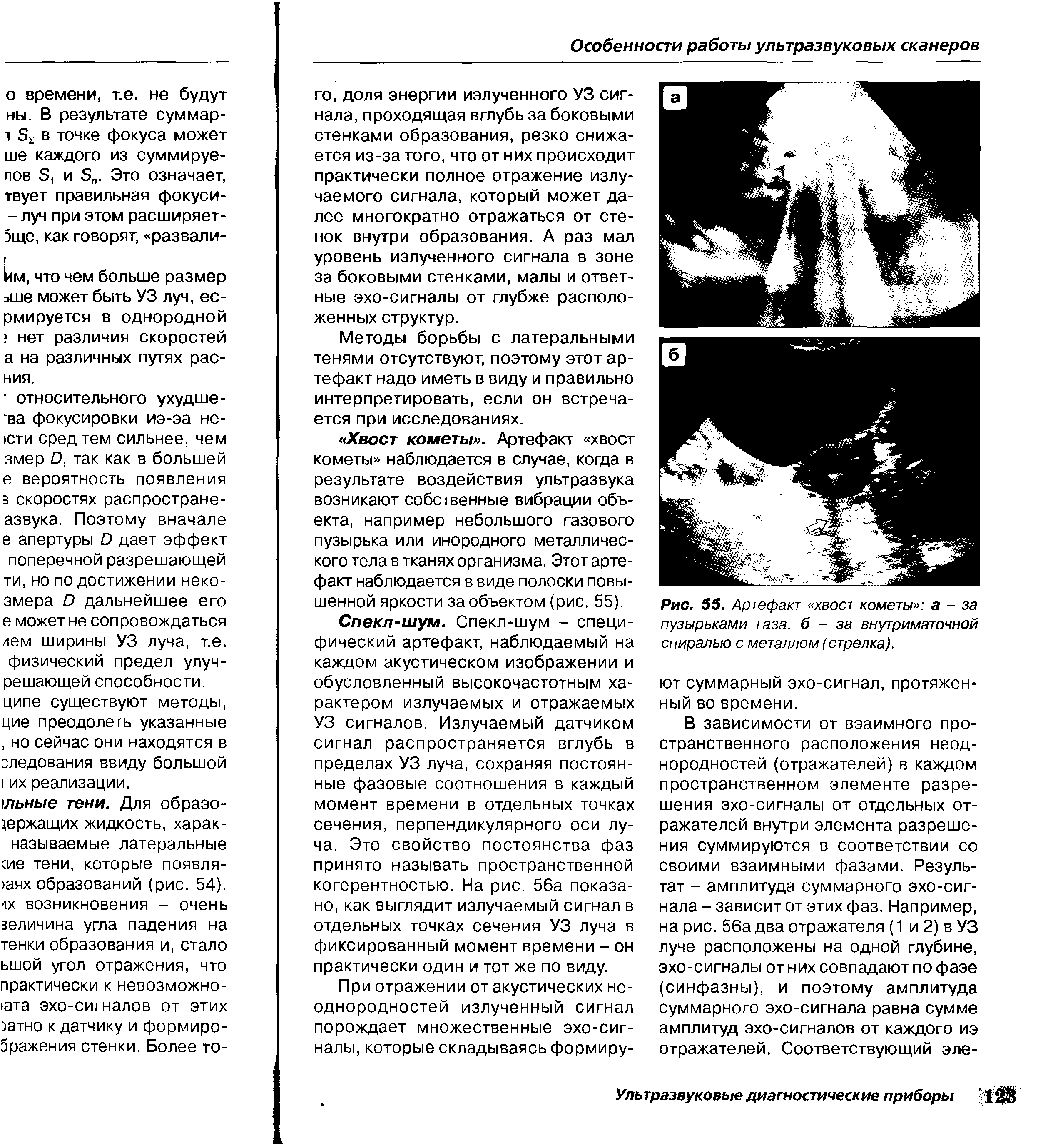 Рис. 55. Артефакт хвост кометы а - за пузырьками газа, б - за внутриматочной спиралью с металлом (стрелка).