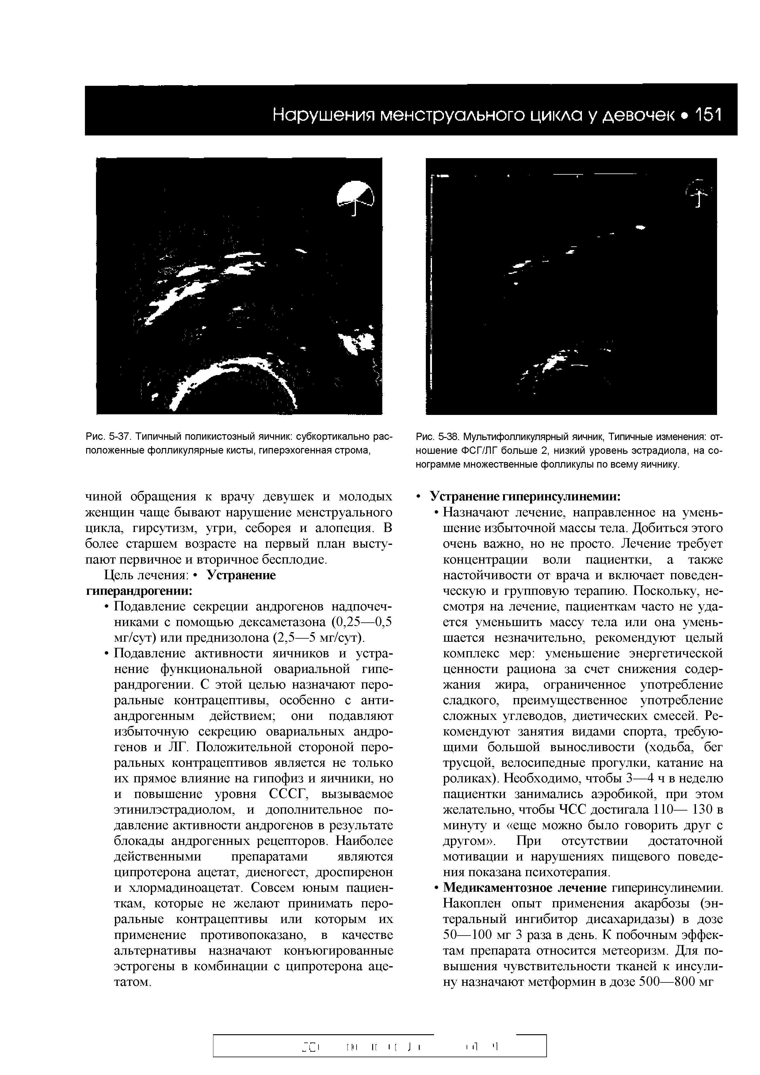 Рис. 5-38. Мультифолликулярный яичник, Типичные изменения отношение ФСГ/ЛГ больше 2, низкий уровень эстрадиола, на сонограмме множественные фолликулы по всему яичнику.