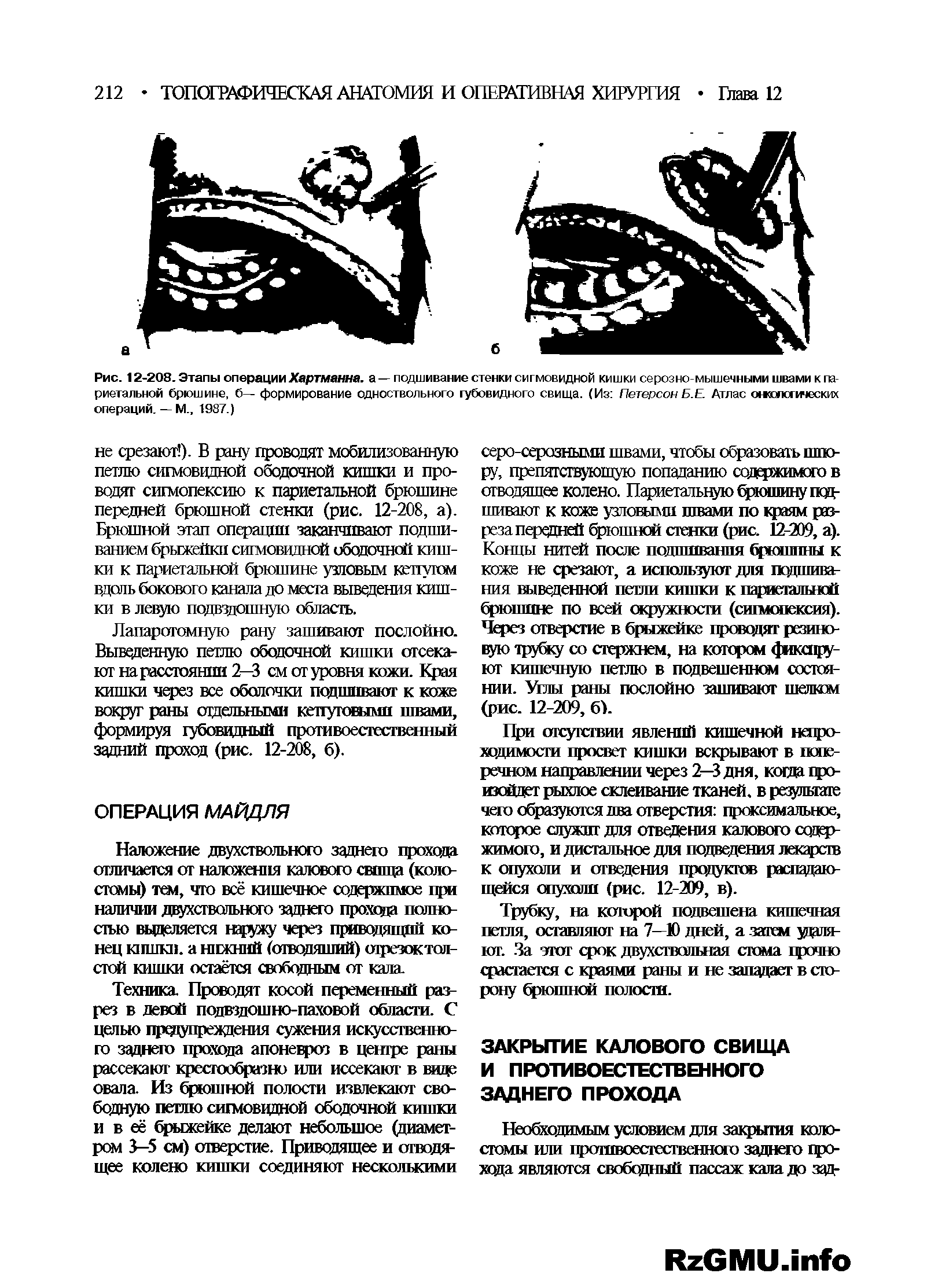 Рис. 12-208. Этапы операции Хартманна, а — подшивание стенки сигмовидной кишки серозно-мышечными швами к париетальной брюшине, б— формирование одноствольного губовидного свища. (Из Петерсон Б. Е. Атлас онкологических операций. — М., 1987.)...