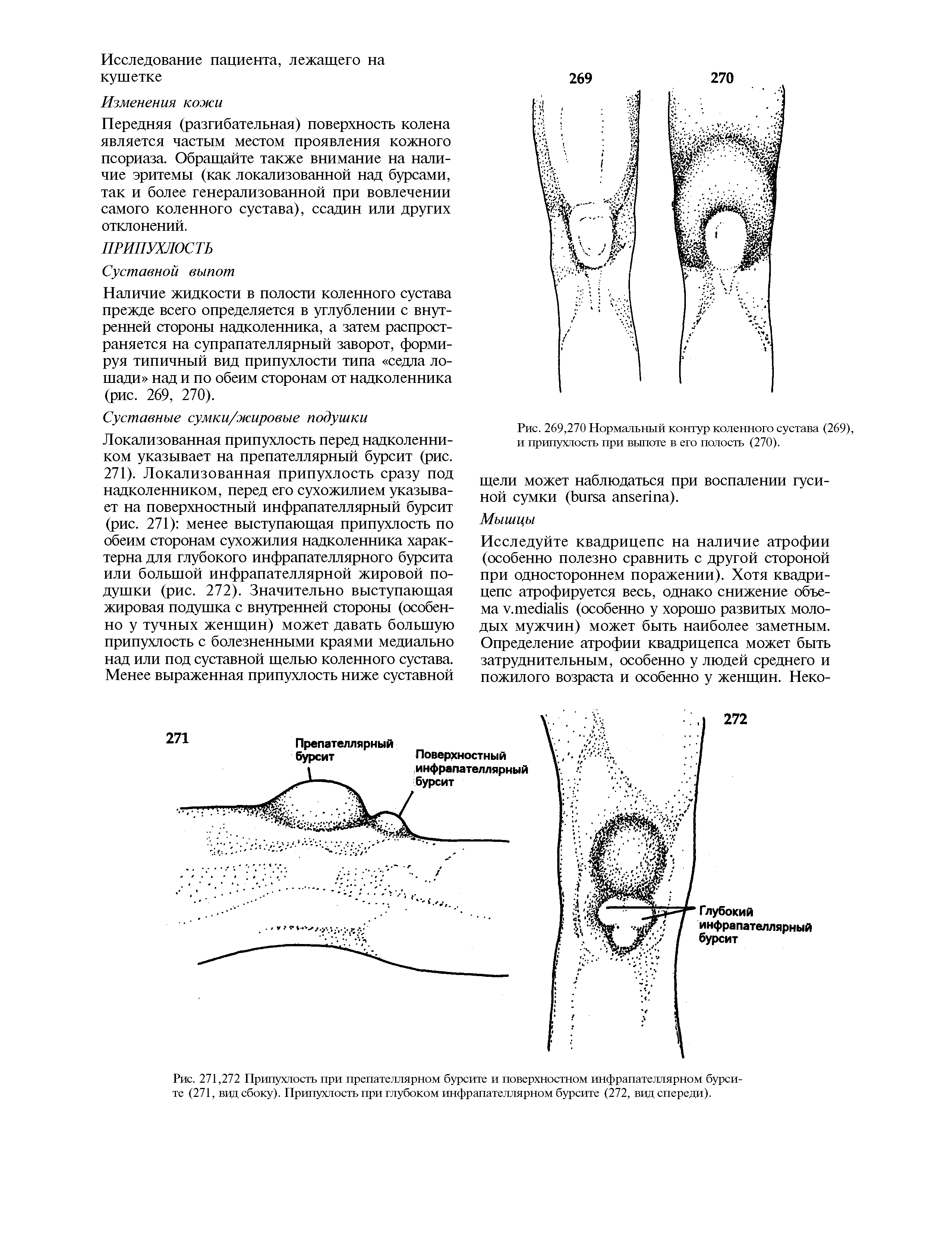Рис. 271,272 Припухлость при препателлярном бурсите и поверхностном инфрапателлярном бурсите (271, вид сбоку). Припухлость при глубоком инфрапателлярном бурсите (272, вид спереди).