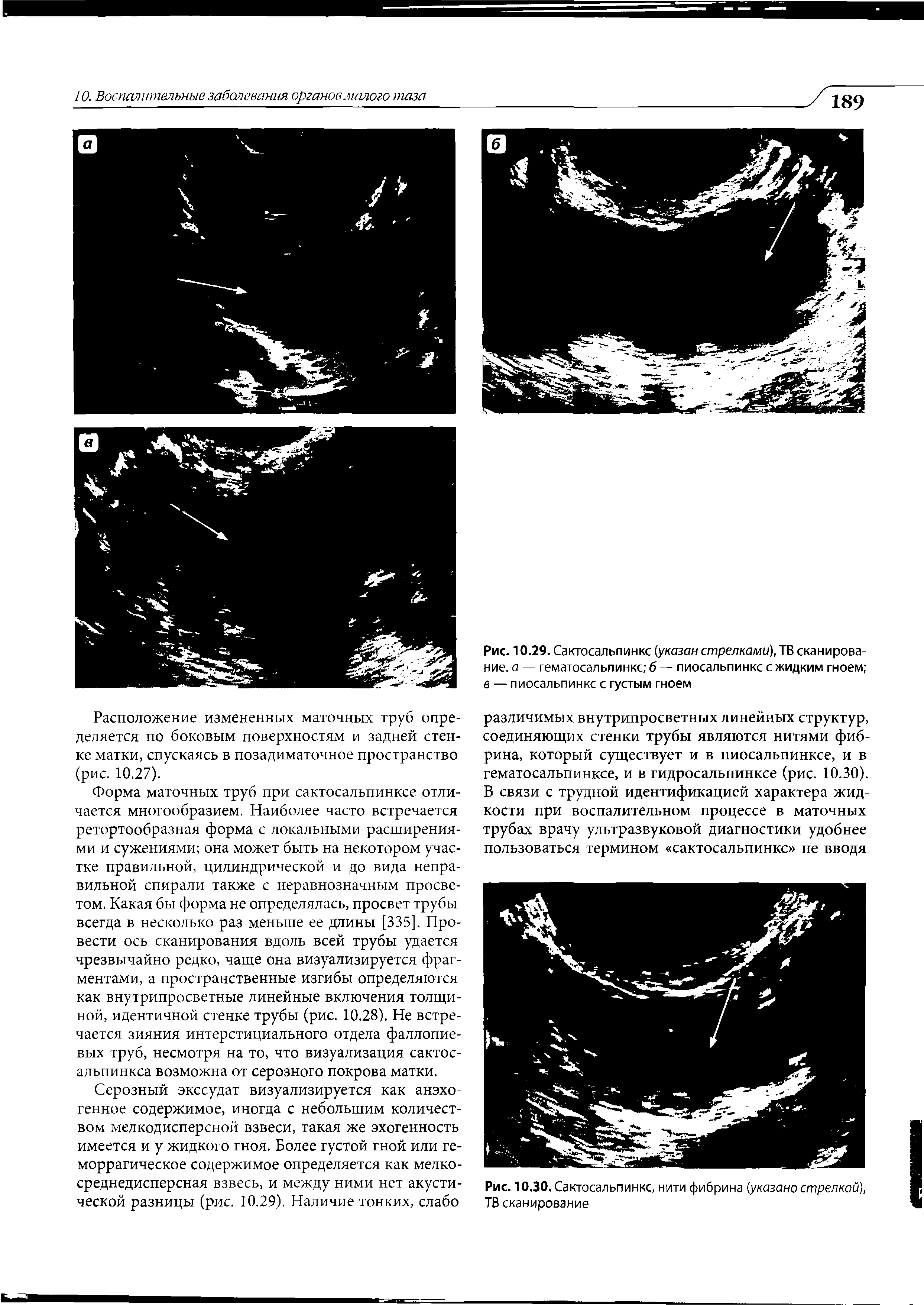 Рис. 10.30. Сактосальпинкс, нити фибрина (указано стрелкой), ТВ сканирование...