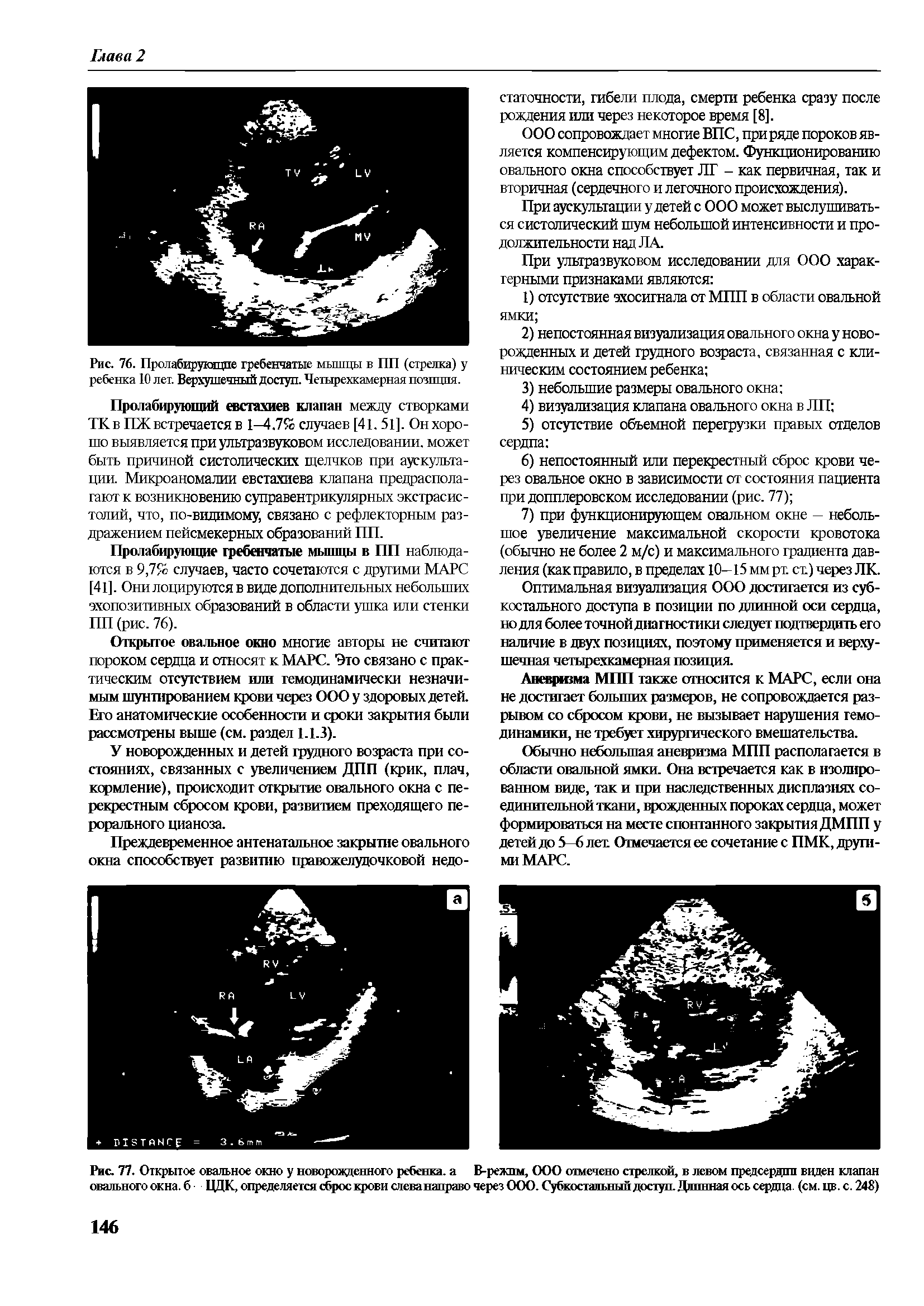 Рис. 77. Открытое овальное окно у новорожденного ребенка, а В-режпм, ООО отмечено стрелкой, в левом предсердии виден клапан овального окна, б ЦДК, определяется сброс крови слева направо через ООО. Субкостальнып доступ. Длинная ось сердца, (см. цв. с. 248)...