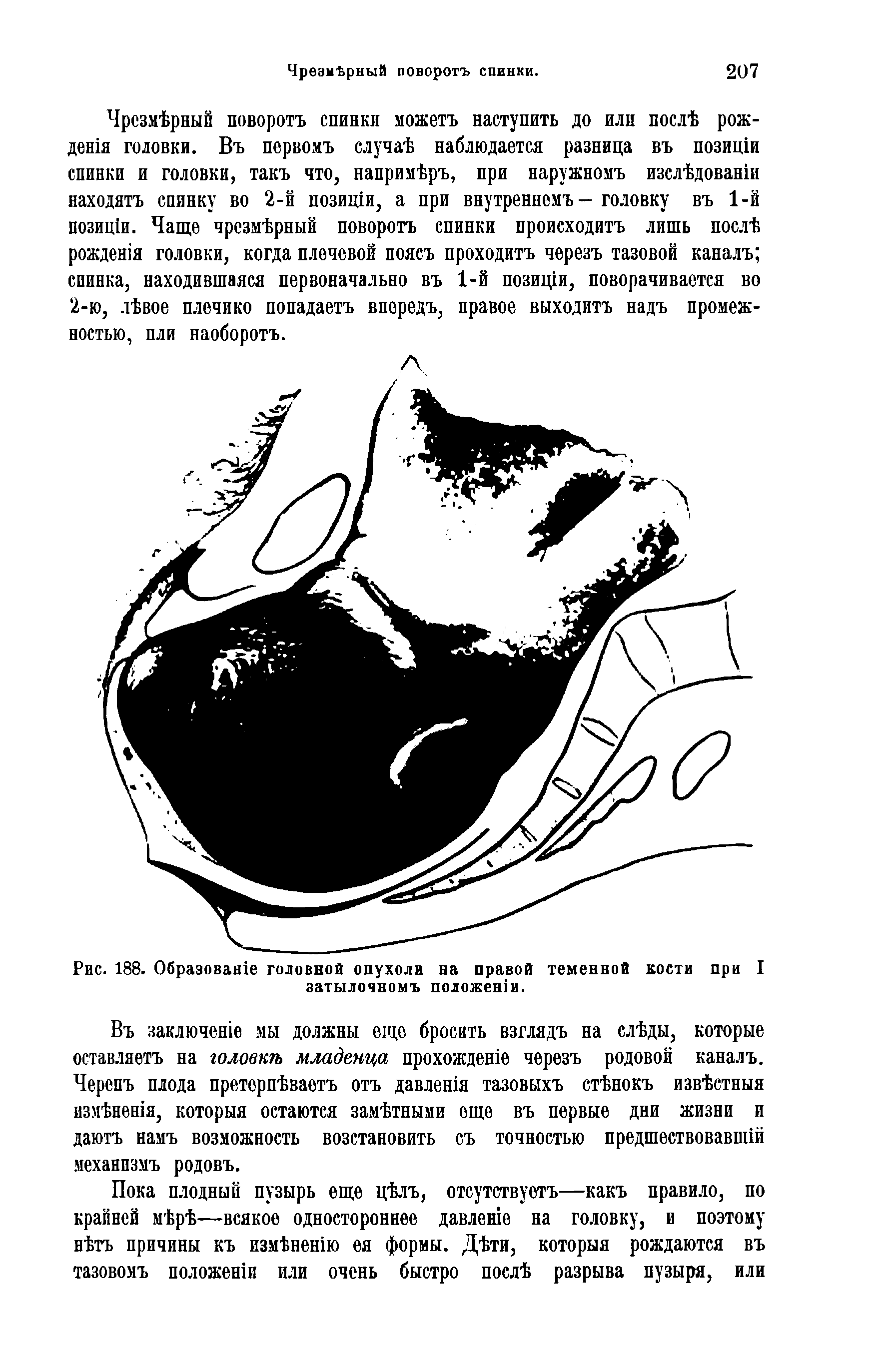 Рис. 188. Образовав головной опухоли на правой теменной кости при I затылочномъ положении.