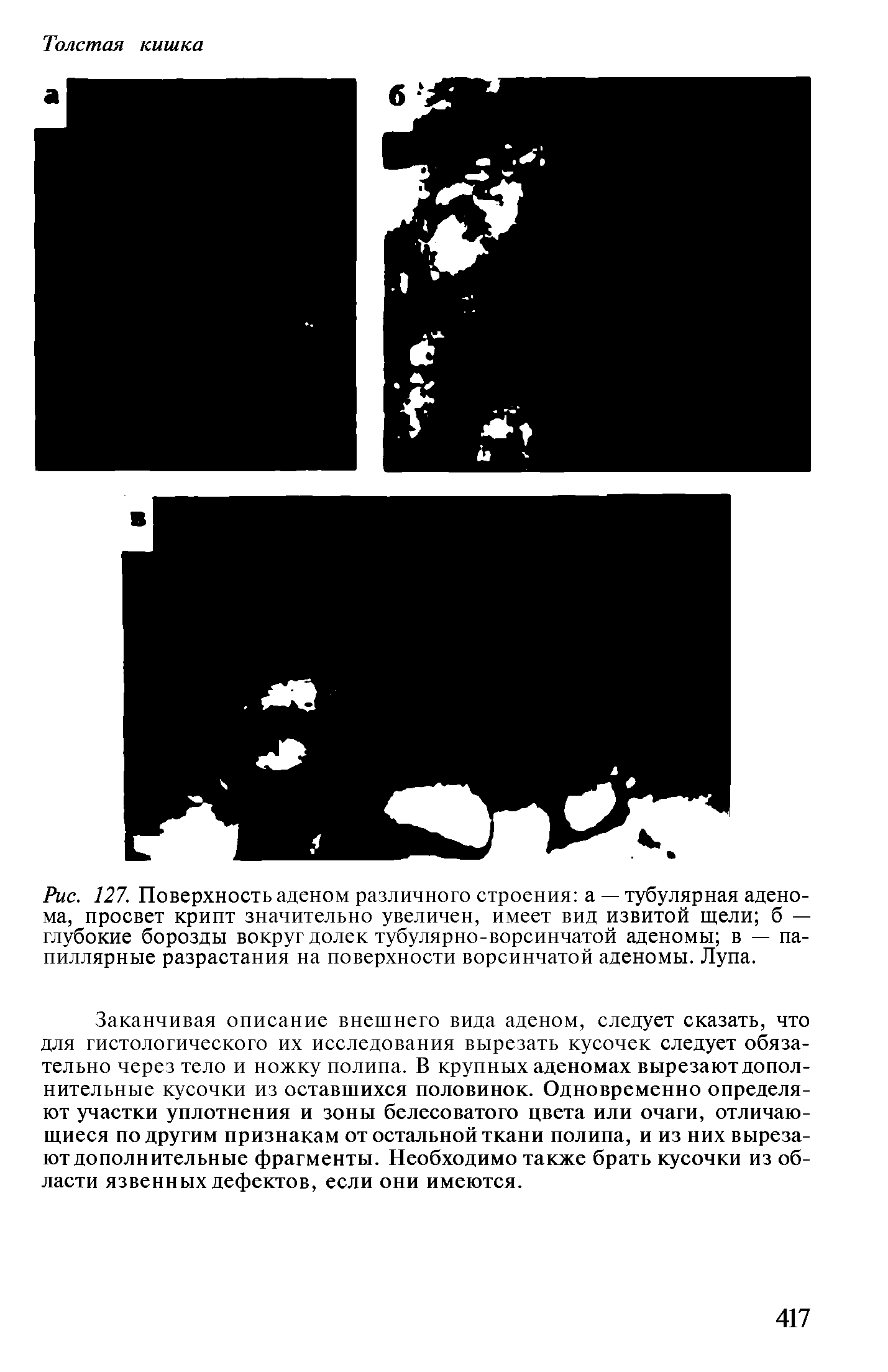 Рис. 127. Поверхность аденом различного строения а — тубулярная аденома, просвет крипт значительно увеличен, имеет вид извитой щели б — глубокие борозды вокруг долек тубулярно-ворсинчатой аденомы в — папиллярные разрастания на поверхности ворсинчатой аденомы. Лупа.