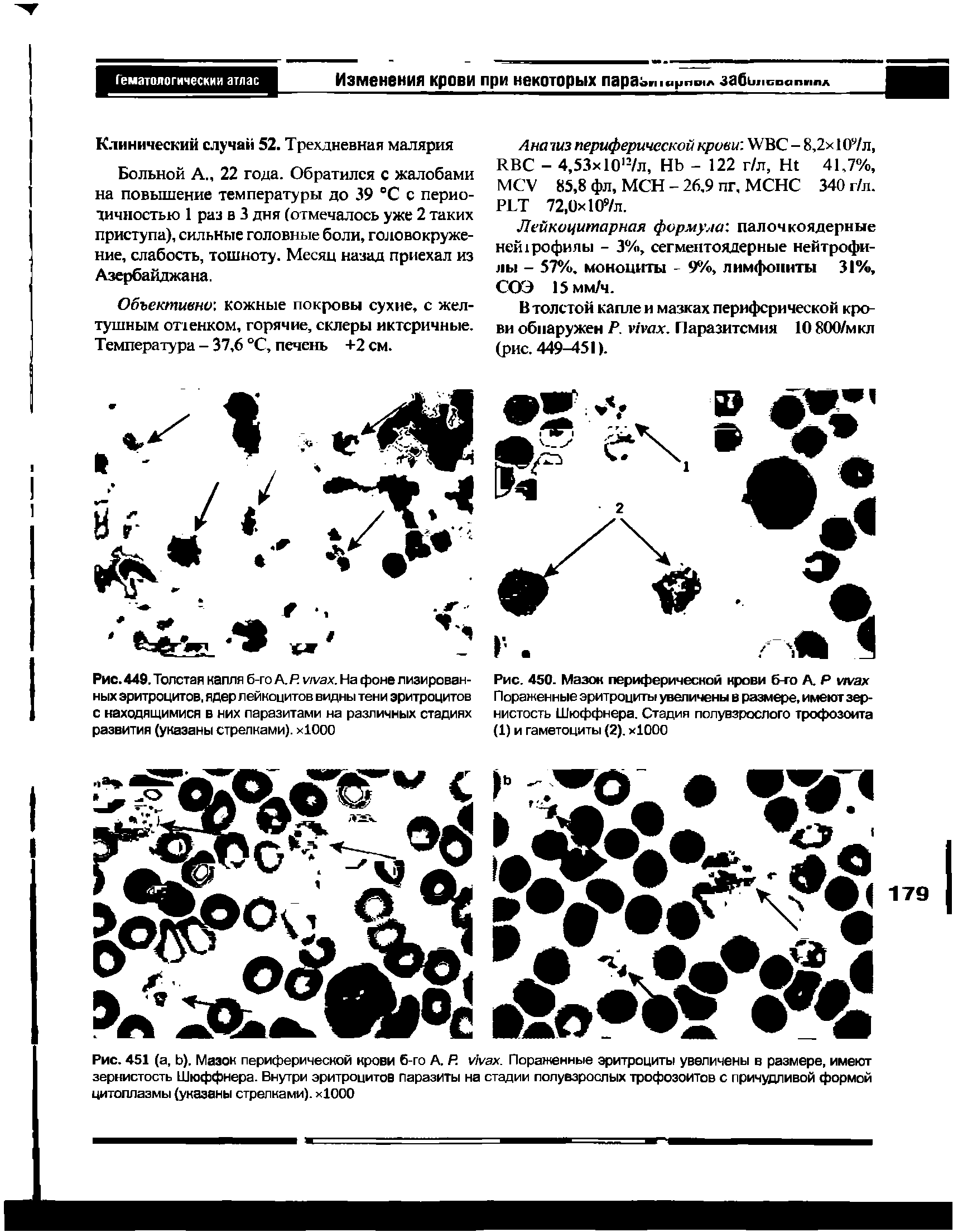 Рис. 450. Мазок периферической нрови б-го А Р ииах Пораженные эритроциты увеличены в размере, имеют зернистость Шюффнера. Стадия полувзрослого трофозоита (1) и гаметоциты (2). хЮОО...