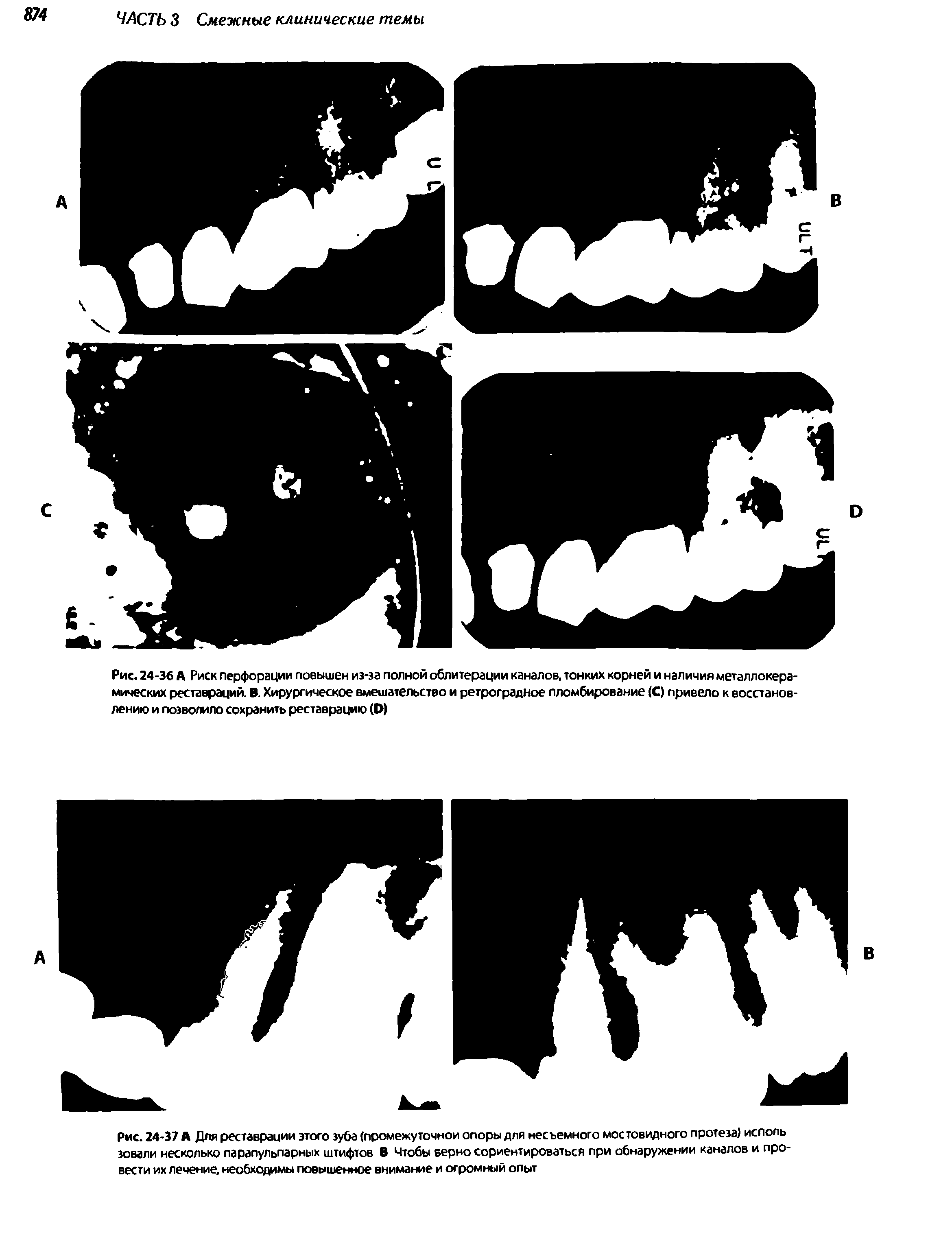 Рис. 24-36 А Риск перфорации повышен из-за полной облитерации каналов, тонких корней и наличия металлокерамических реставраций. В. Хирургическое вмешательство и ретроградное пломбирование (С) привело к восстановлению и позволило сохранить реставрацию (О)...