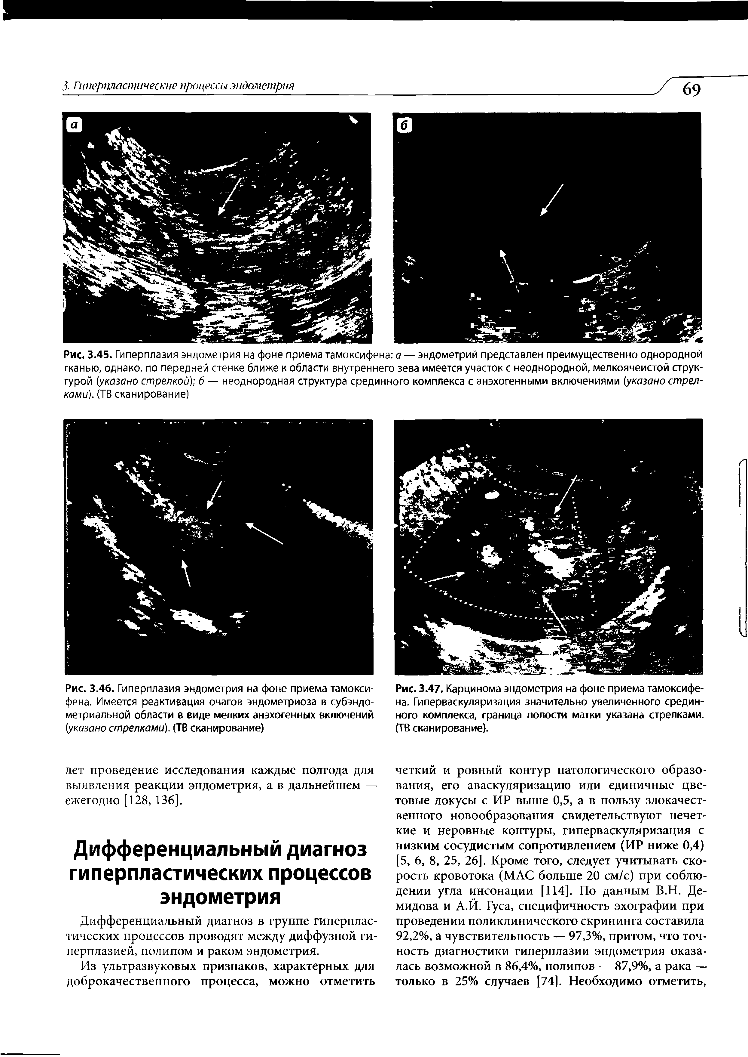 Рис. 3.46. Гиперплазия эндометрия на фоне приема тамоксифена. Имеется реактивация очагов эндометриоза в субэндометриальной области в виде мелких анэхогенных включений (указано стрелками). (ТВ сканирование)...