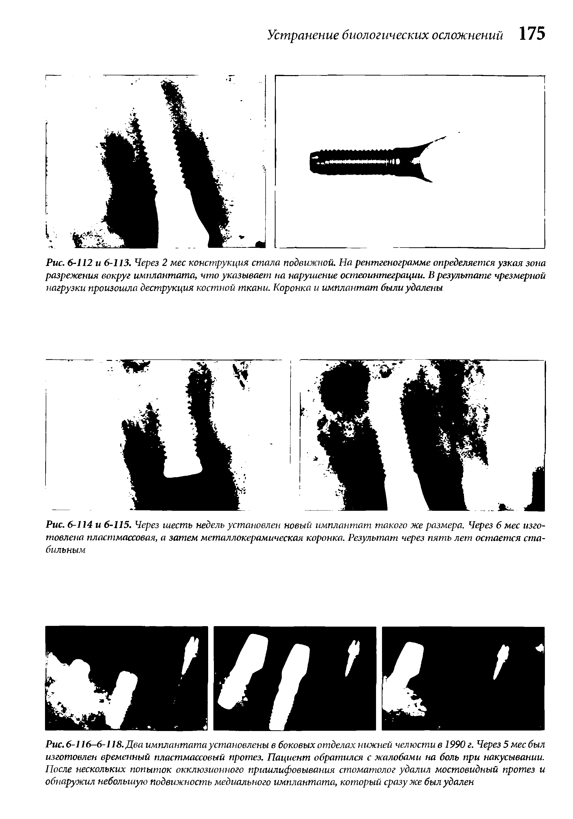 Рис. 6-116-6-118. Два имплантата установлены в боковых отделах нижней челюсти в 1990 г. Через 5 мес был изготовлен временный пластмассовый протез. Пациент обратился с жалобами на боль при накусывании. После нескольких попыток окклюзионного пришлифовывания стоматолог удалил мостовидный протез и обнаружил небольшую подвижность медиального имплантата, который сразу же был удален...