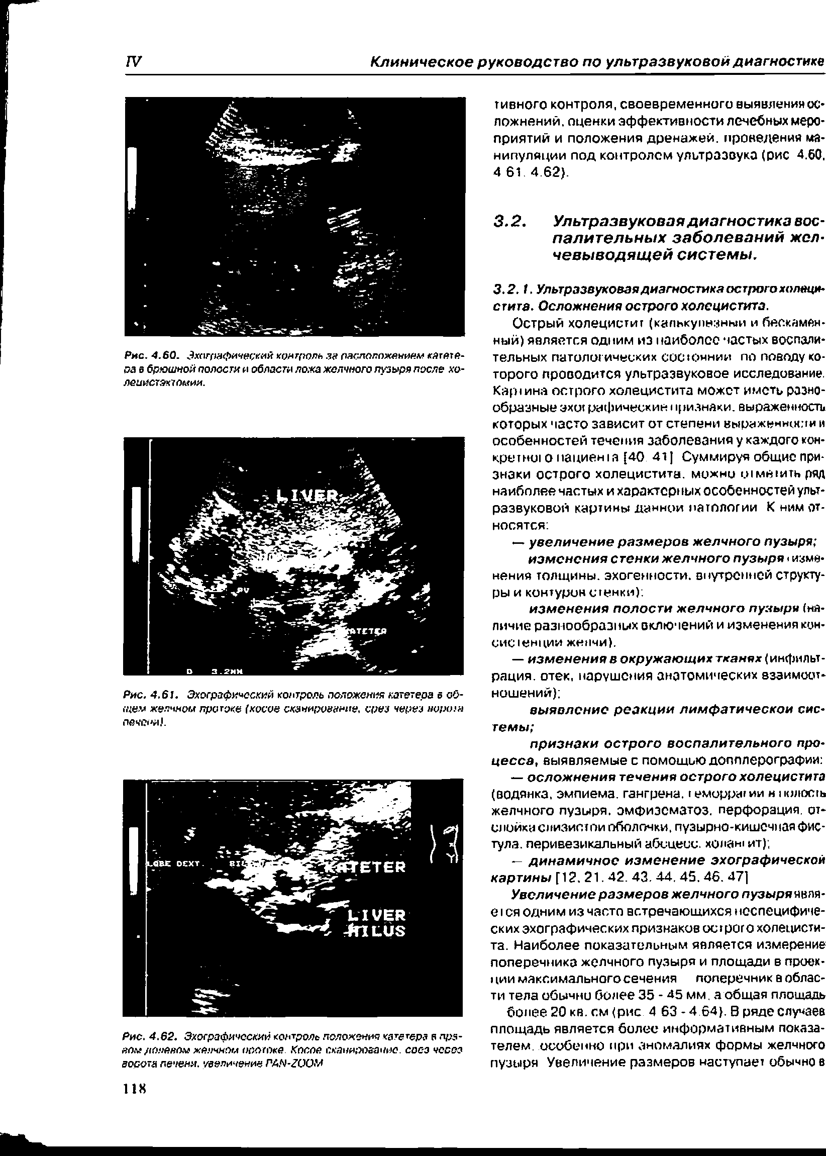 Рис. 4.62. Эхографический контроль положения катетера в -тра-ег)м лопввом желчном оооггже Косое сканирование, чссез ворота печени, увеличение PA.4-ZOOM...