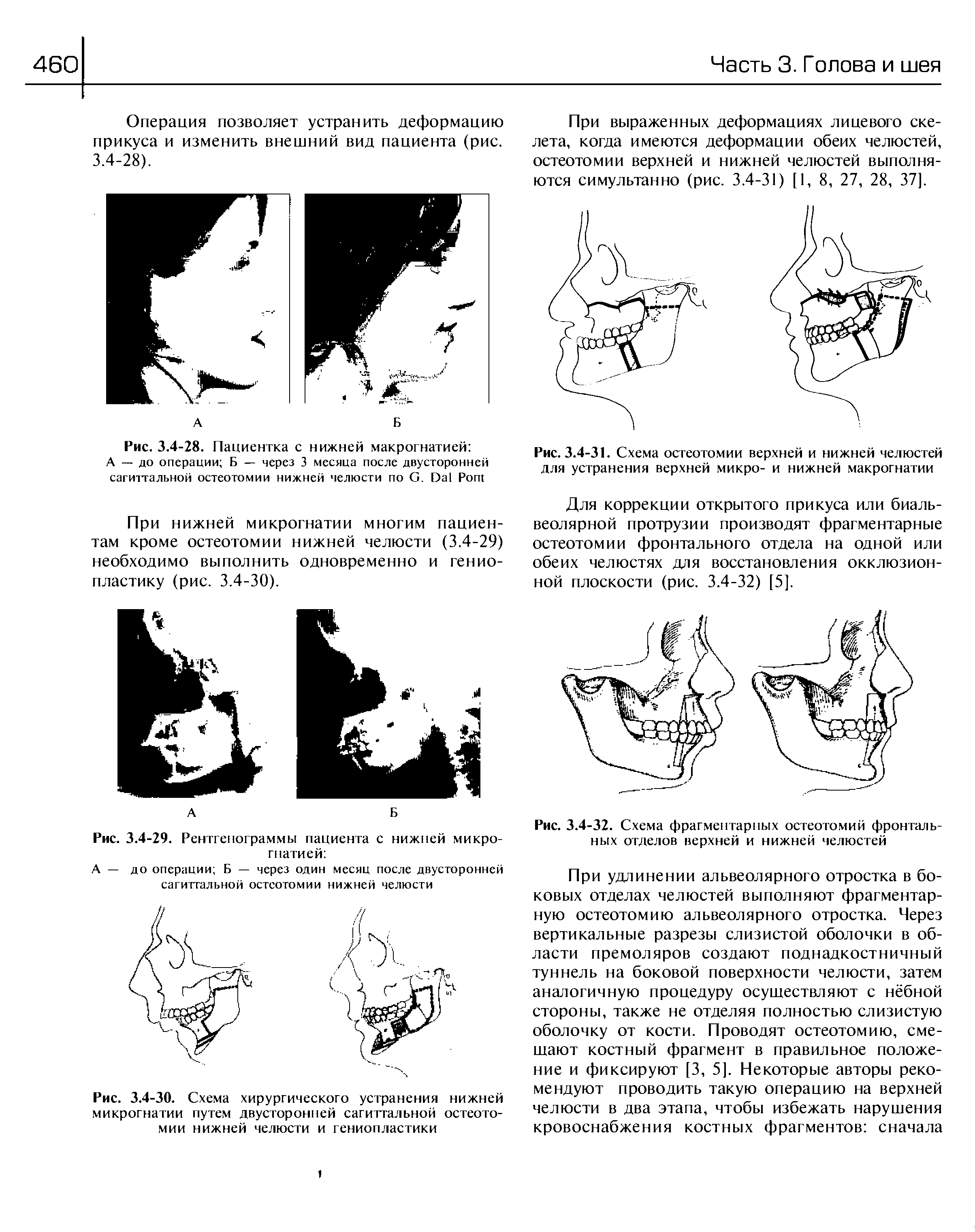 Рис. 3.4-30. Схема хирургического устранения нижней микрогнатии путем двусторонней сагиттальной остеотомии нижней челюсти и гениопластики...