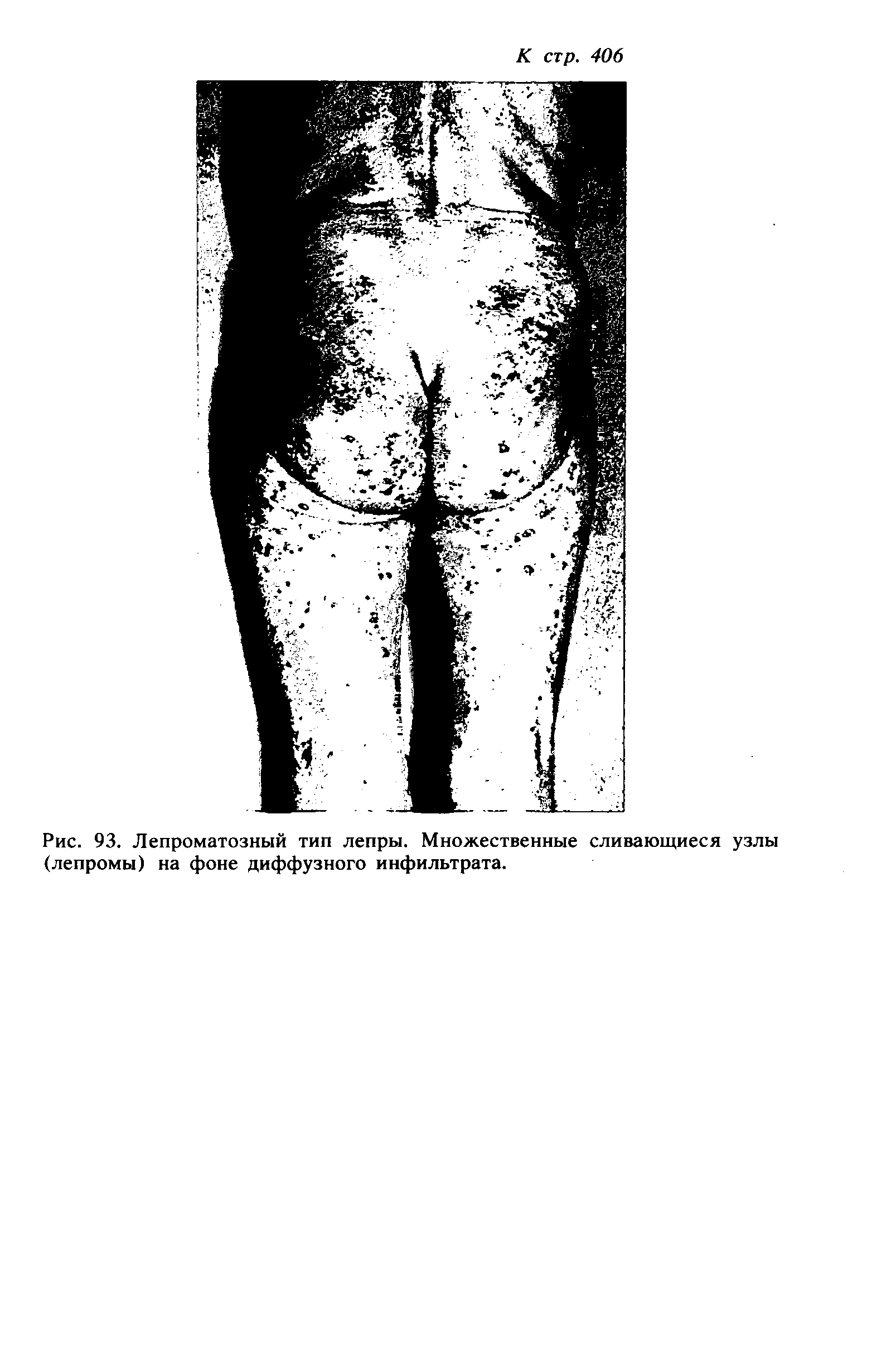 Рис. 93. Лепроматозный тип лепры. Множественные сливающиеся узлы (лепромы) на фоне диффузного инфильтрата.