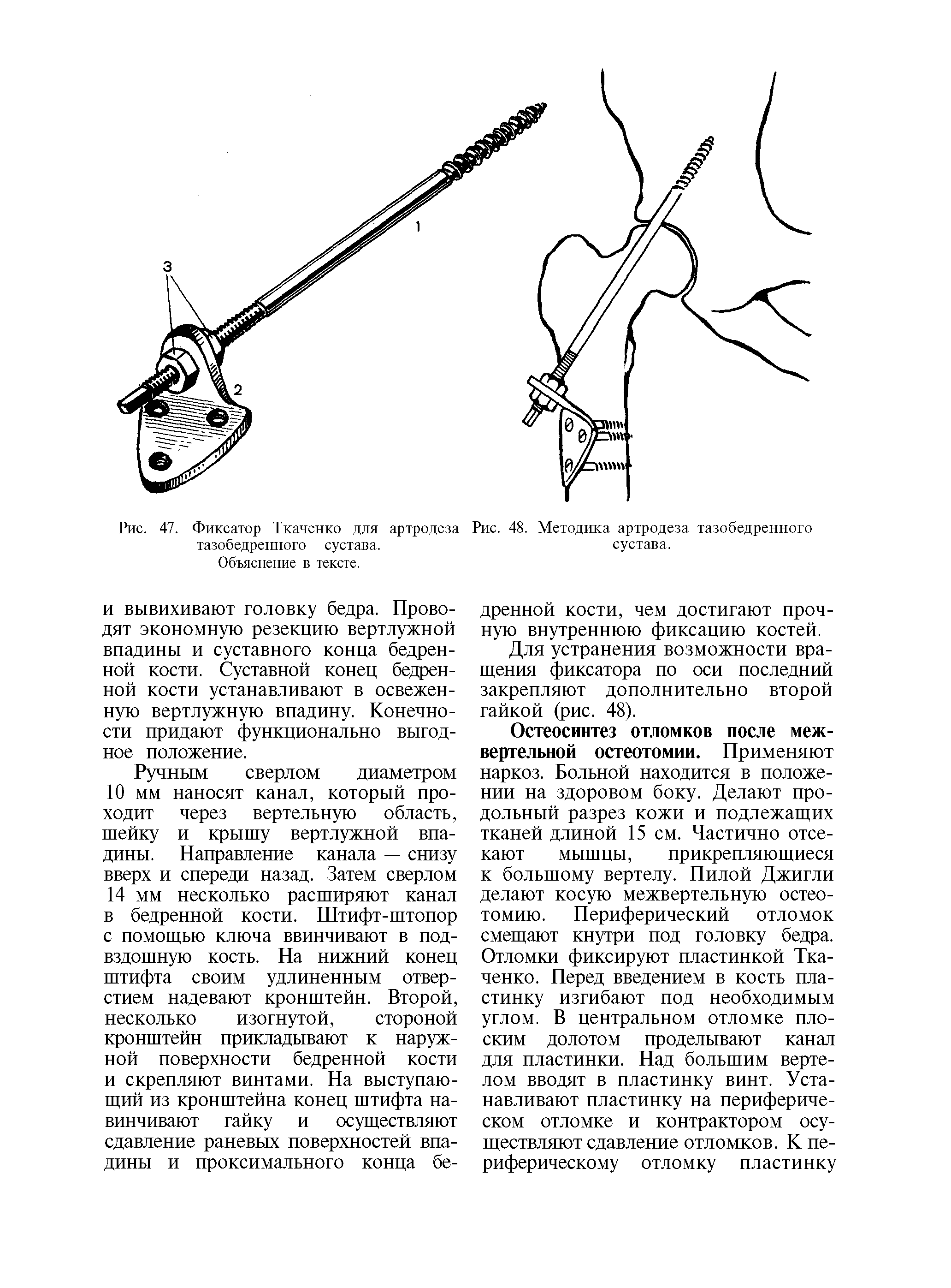 Рис. 47. Фиксатор Ткаченко для артродеза тазобедренного сустава. Объяснение в тексте.