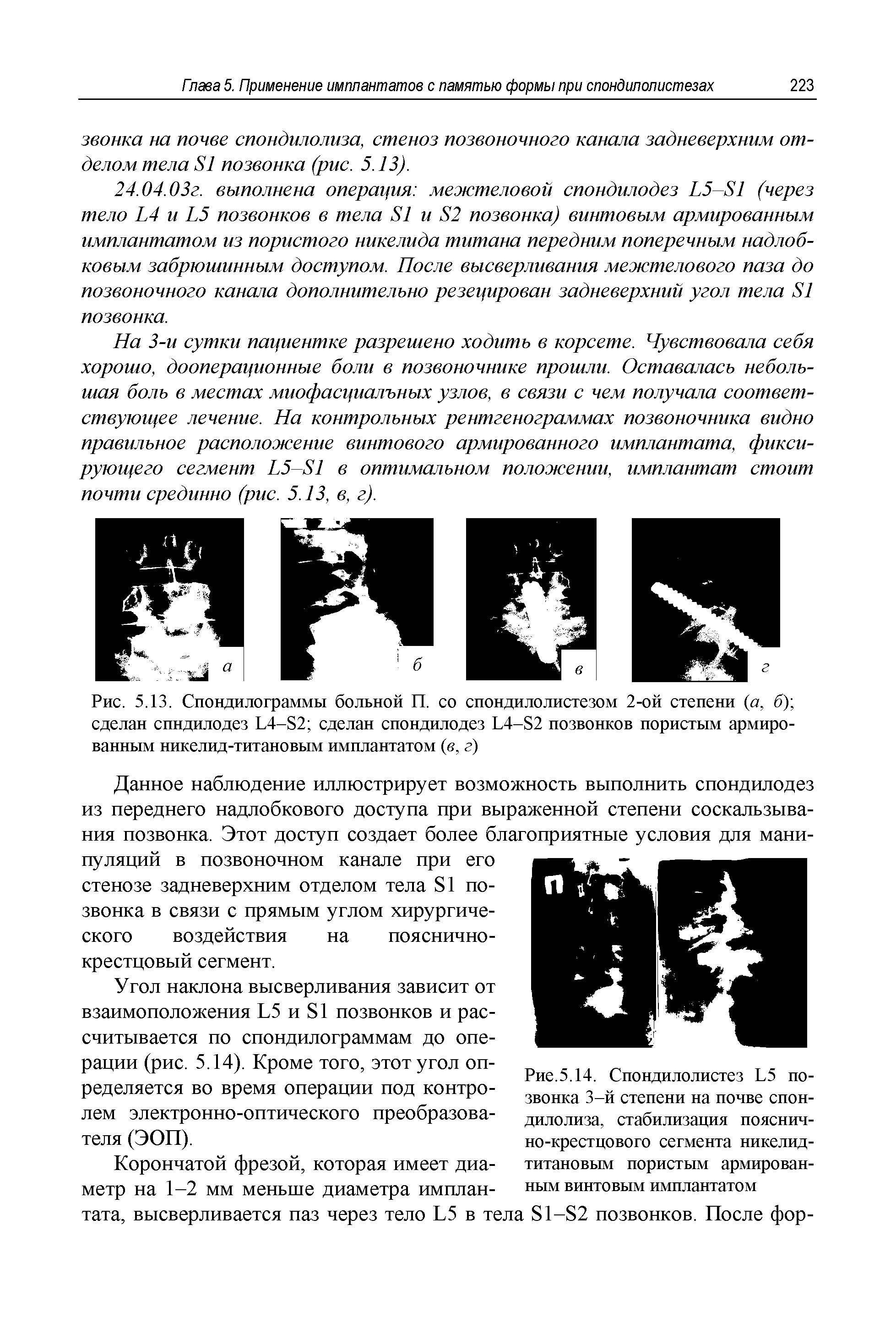 Рис. 5.13. Спондилограммы больной П. со спондилолистезом 2-ой степени (а, б) сделан спндилодез Ь4-82 сделан спондилодез Ь4-82 позвонков пористым армированным никелид-титановым имплантатом (в, г)...