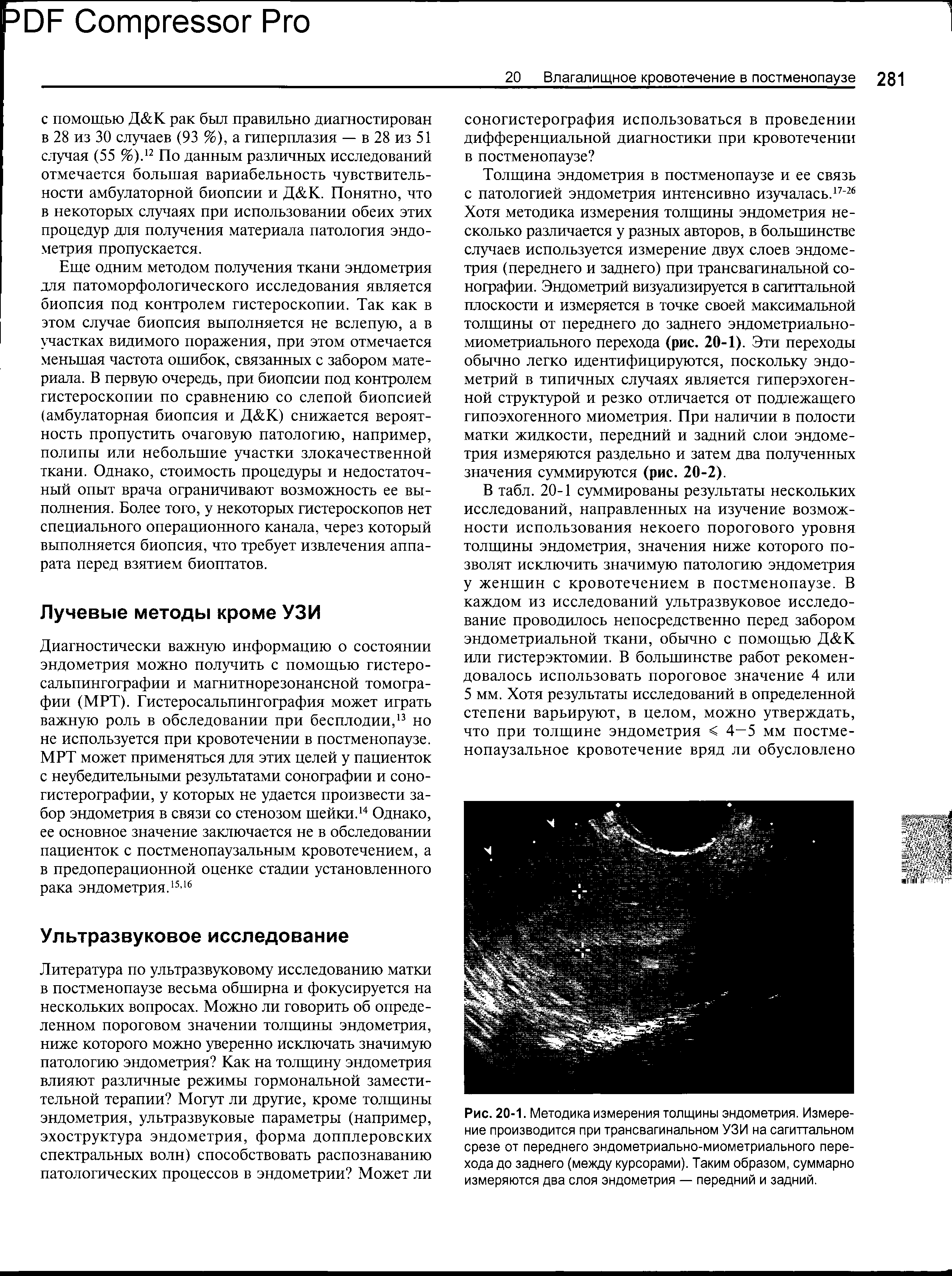 Рис. 20-1. Методика измерения толщины эндометрия. Измерение производится при трансвагинапьном УЗИ на сагиттальном срезе от переднего эндометриально-миометриального перехода до заднего (между курсорами). Таким образом, суммарно измеряются два слоя эндометрия — передний и задний.