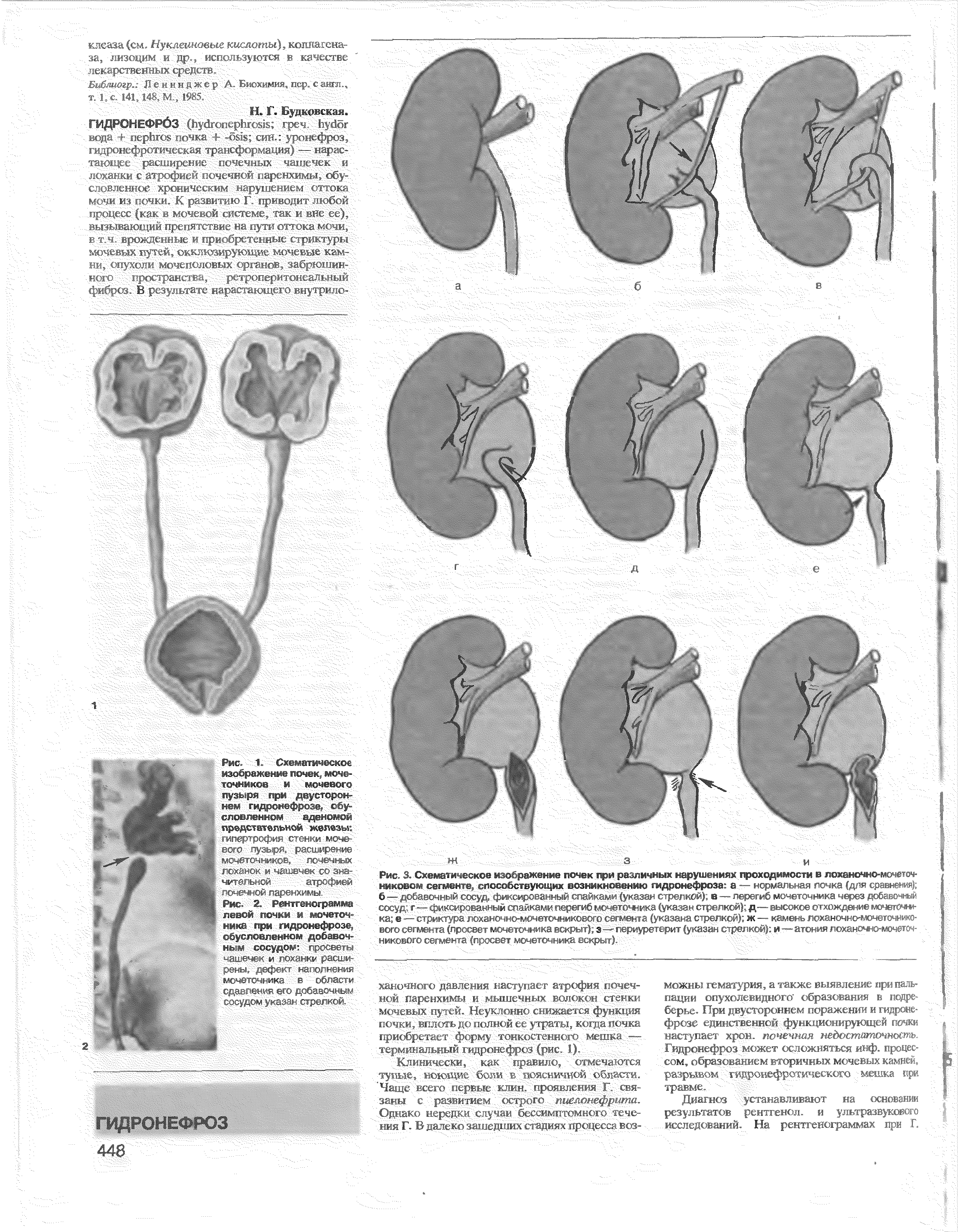 Рис. 3. Схематическое изображение почек при различных нарушениях проходимости в лоханочно-мочеточниковом допленте, способствующих возникновению гидронефроза а — нормальная почка (для сравнения) б— д л тор < ш л > г > елкой) и — перегиб мочеточника через добавочны...