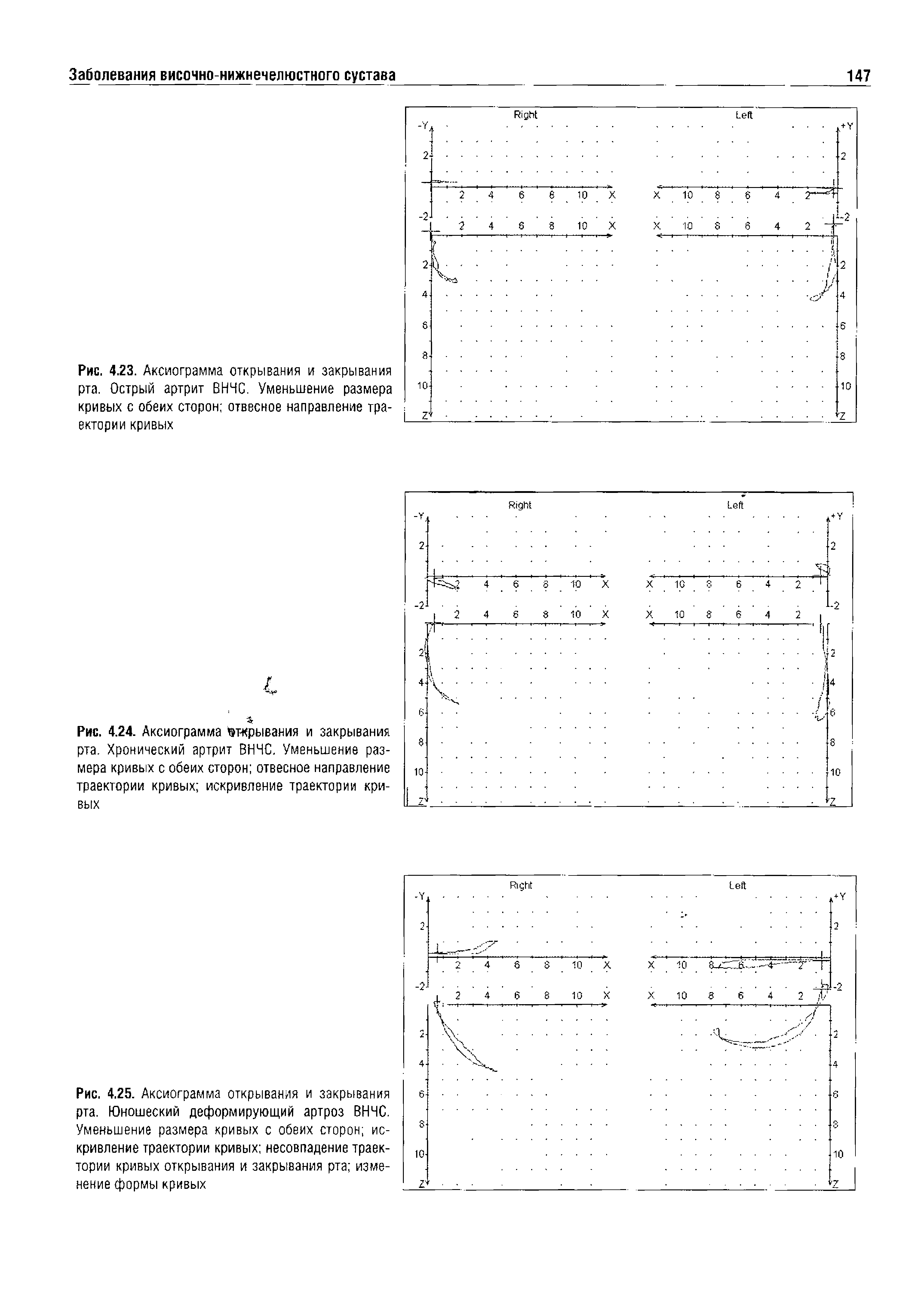 Рис. 4.24. Аксиограмма открывания и закрывания рта. Хронический артрит ВНЧС. Уменьшение размера кривых с обеих сторон отвесное направление траектории кривых искривление траектории кривых...