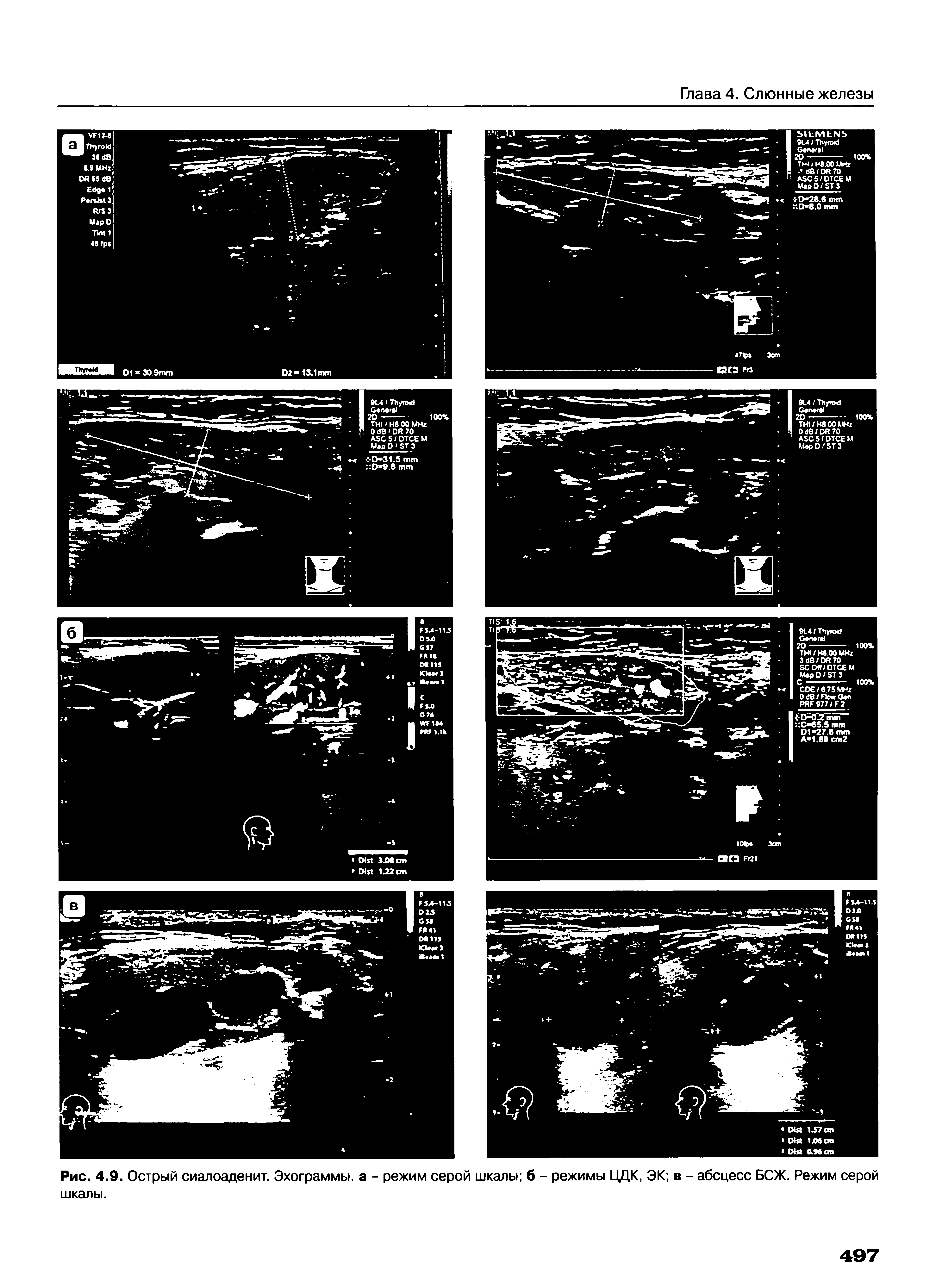 Рис. 4.9. Острый сиалоаденит. Эхограммы, а - режим серой шкалы б - режимы ЦДК, ЭК в - абсцесс БСЖ. Режим серой шкалы.