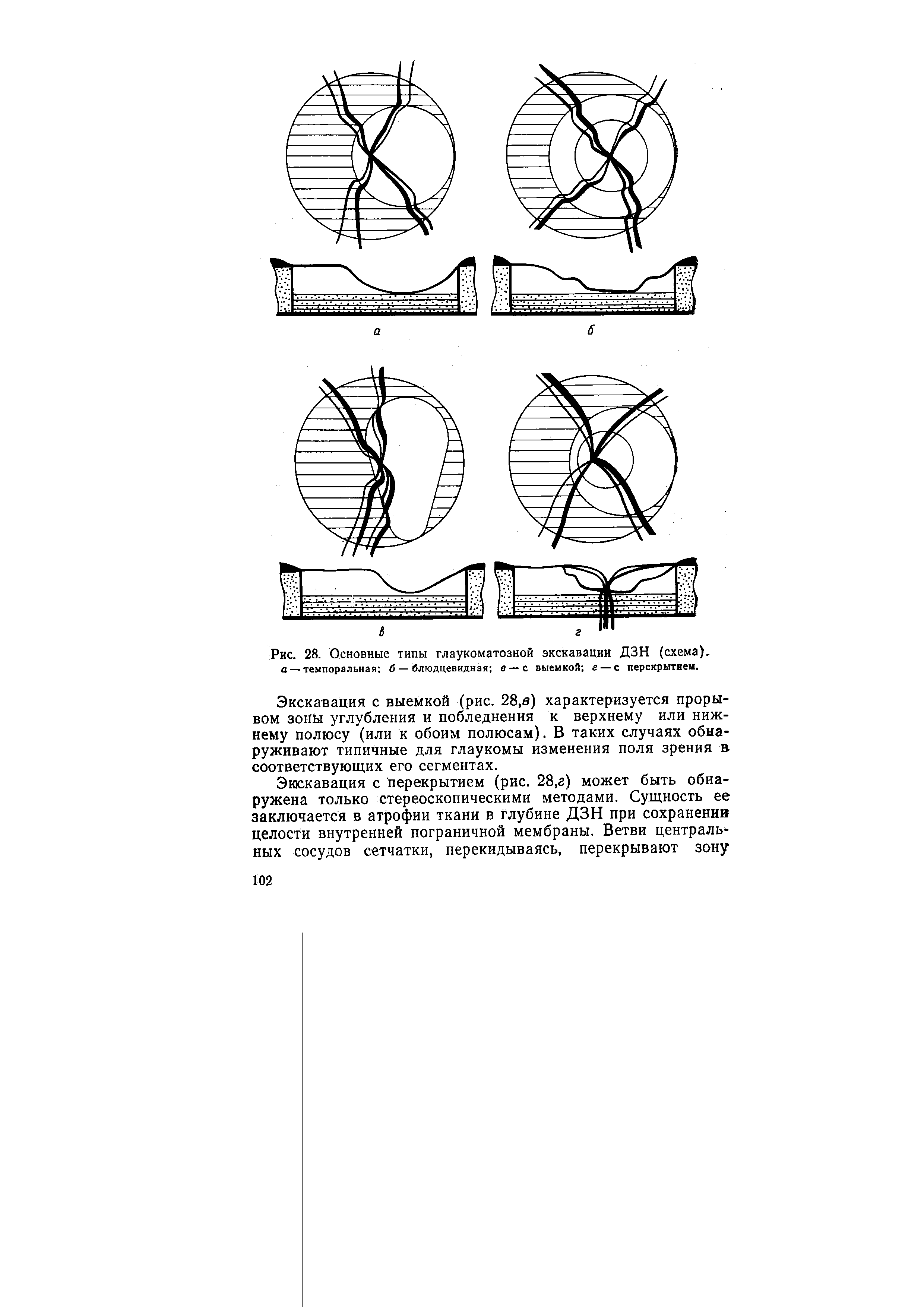 Рис. 28. Основные типы глаукоматозной экскавации ДЗН (схема). а — темпоральная б — блюдцевидная в —с выемкой г — с перекрытием.