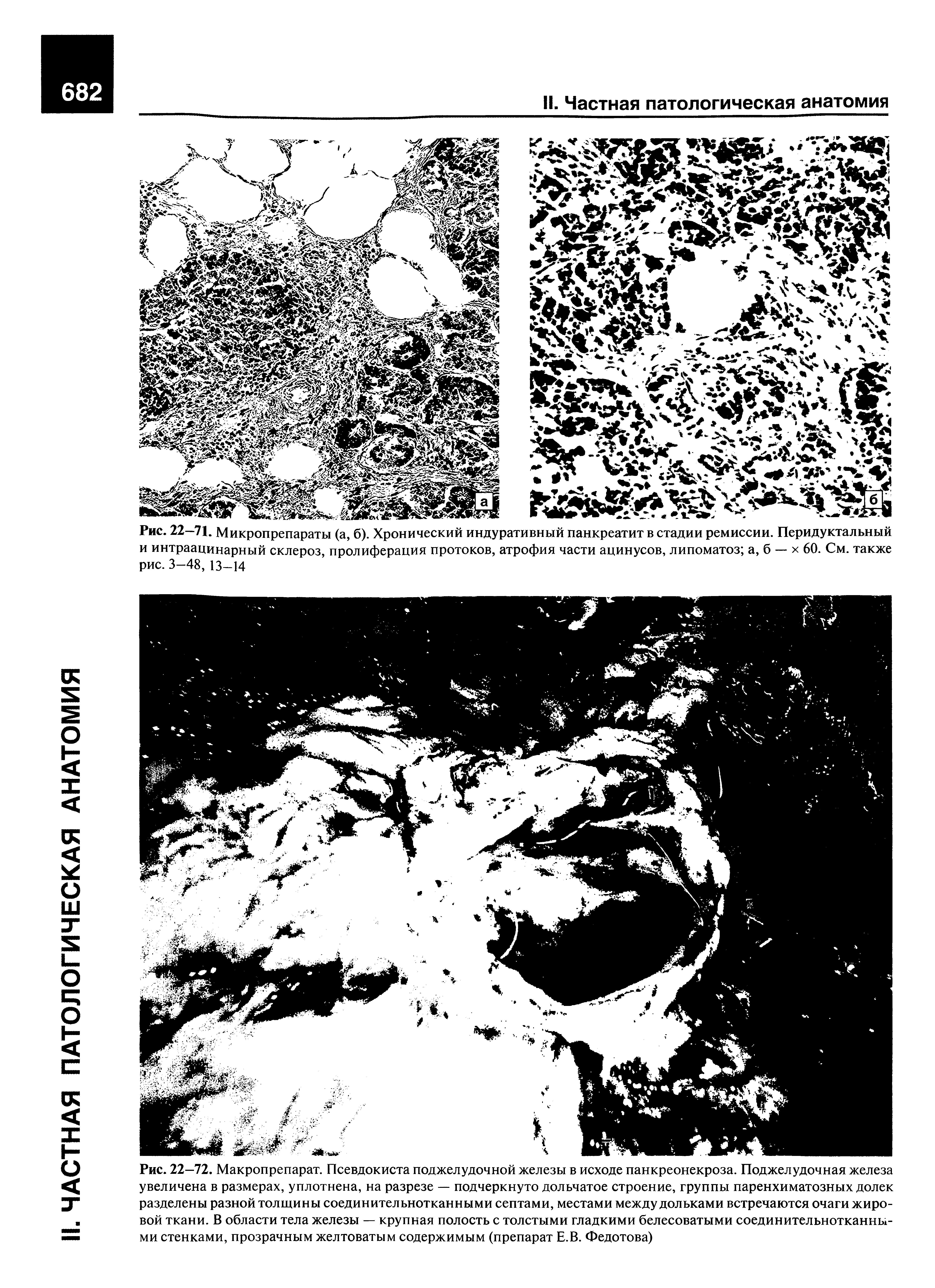 Рис. 22—71. Микропрепараты (а, б). Хронический индуративный панкреатит в стадии ремиссии. Перидуктальный и интраацинарный склероз, пролиферация протоков, атрофия части ацинусов, липоматоз а, б — х 60. См. также рис. 3-48, 13-14...