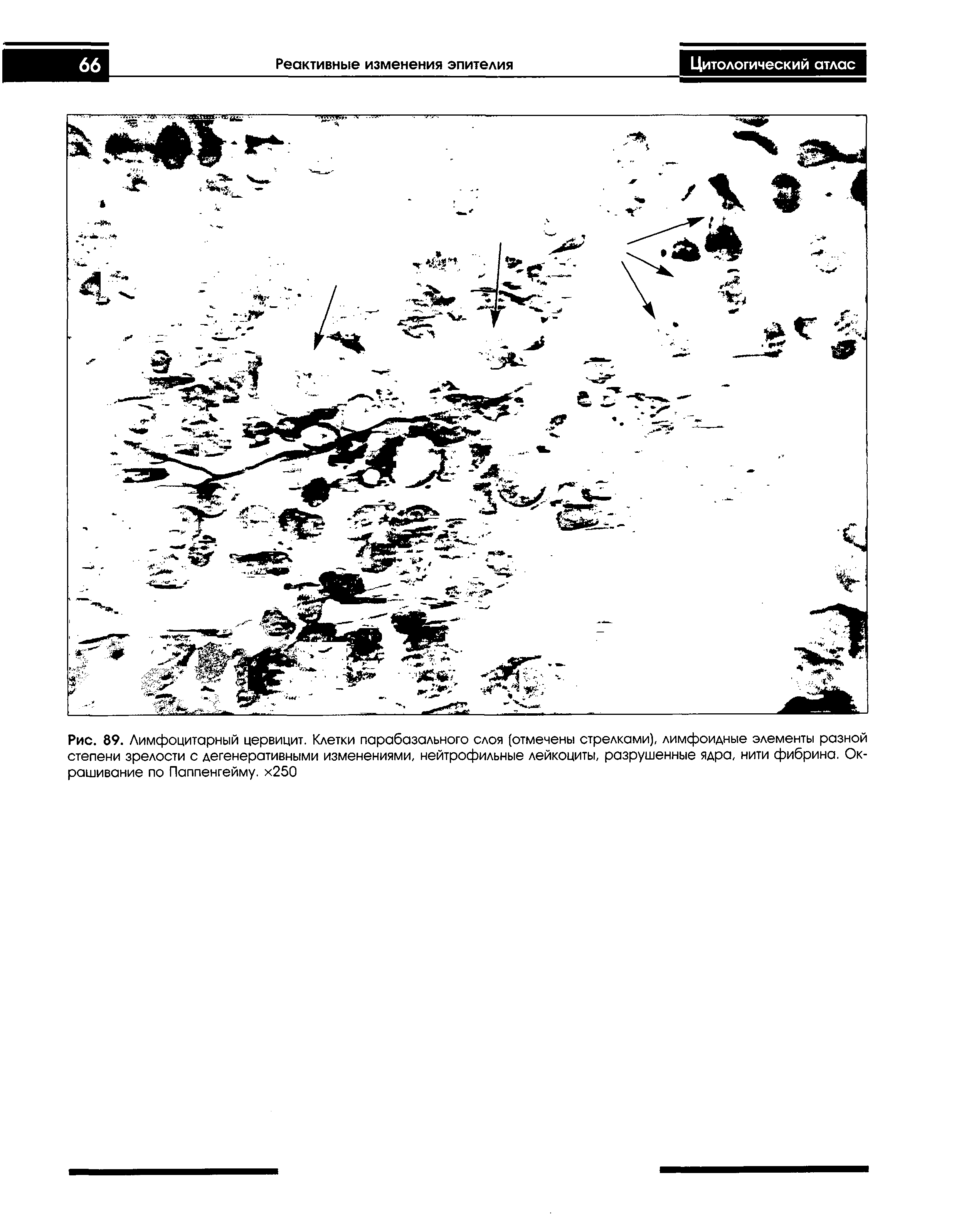 Рис. 89. Лимфоцитарный цервицит. Клетки парабазального слоя (отмечены стрелками), лимфоидные элементы разной степени зрелости с дегенеративными изменениями, нейтрофильные лейкоциты, разрушенные ядра, нити фибрина. Окрашивание по Паппенгейму. х250...