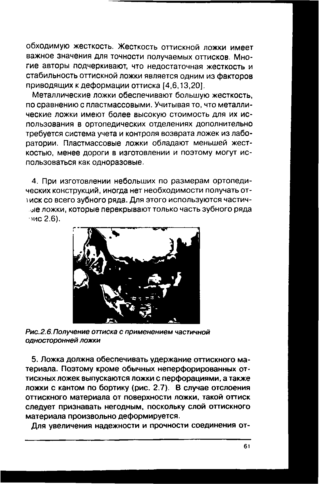 Рис.2.6. Получение оттиска с применением частичной односторонней ложки...