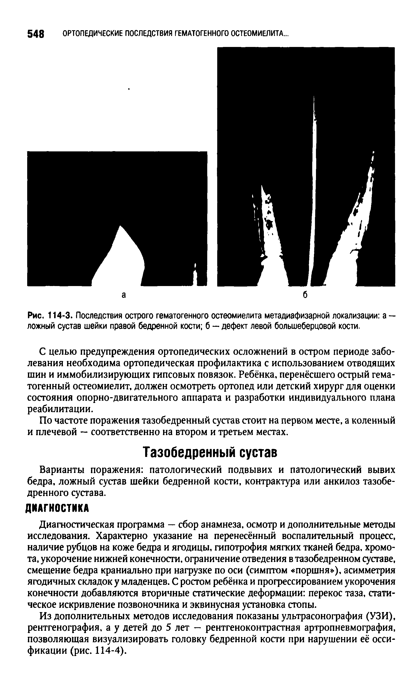 Рис. 114-3. Последствия острого гематогенного остеомиелита метадиафизарной локализации а — ложный сустав шейки правой бедренной кости б — дефект левой большеберцовой кости.