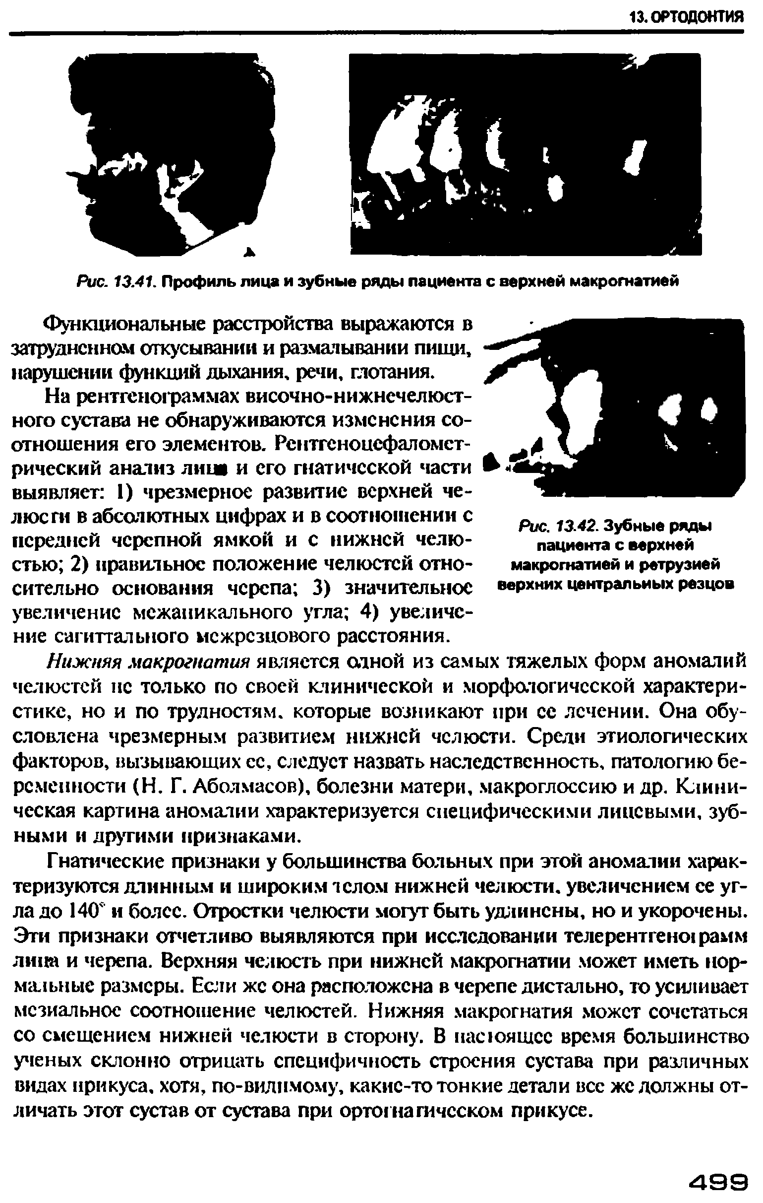 Рис. 13.42. Зубные ряды пациента с верхней макрогнатией и ретрузией верхних центральных резцов...