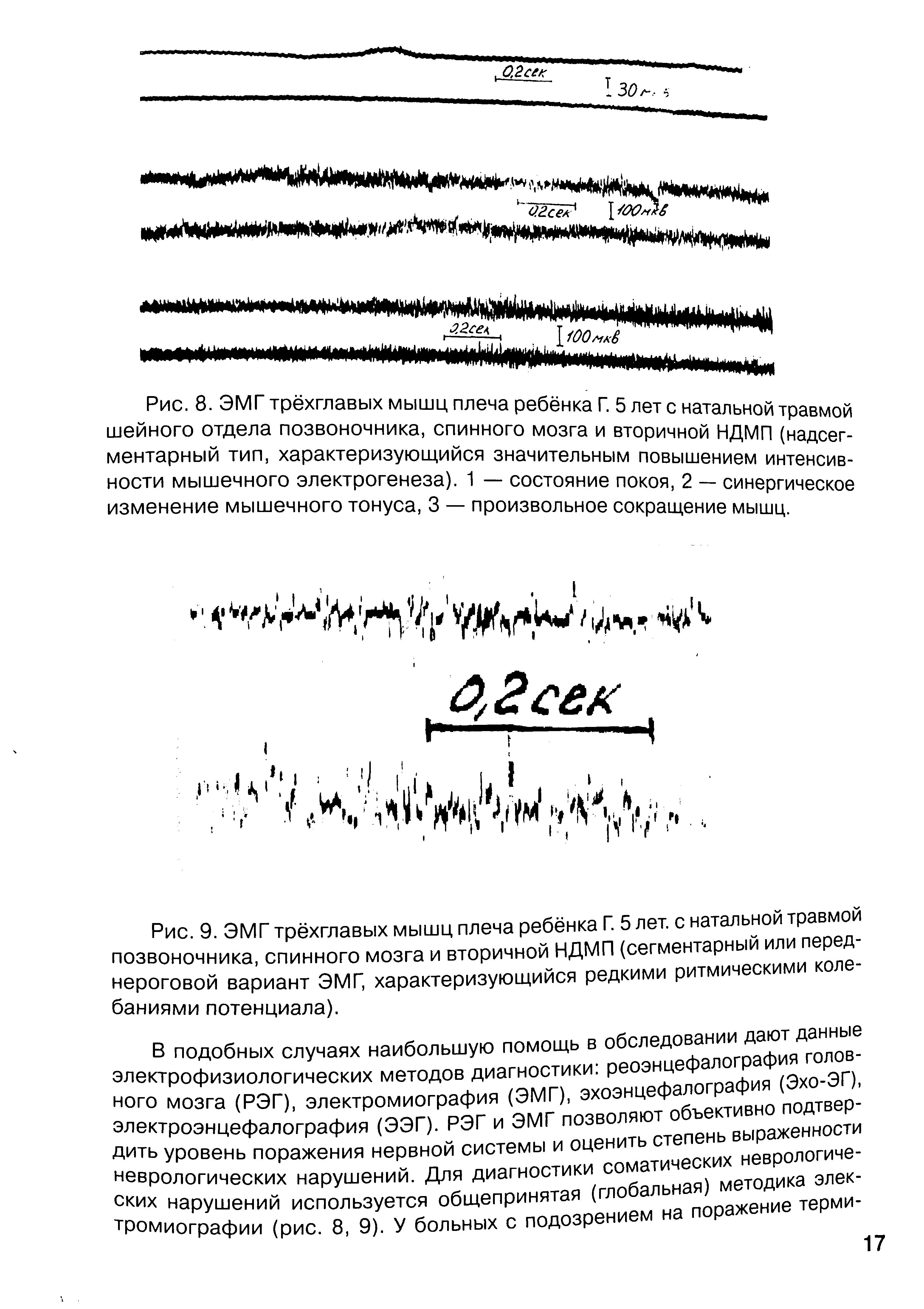 Рис. 9. ЭМГ трёхглавых мышц плеча ребёнка Г. 5 лет. с натальной травмой позвоночника, спинного мозга и вторичной НДМП (сегментарный ил коле-нероговой вариант ЭМГ, характеризующийся редкими ритмич баниями потенциала).