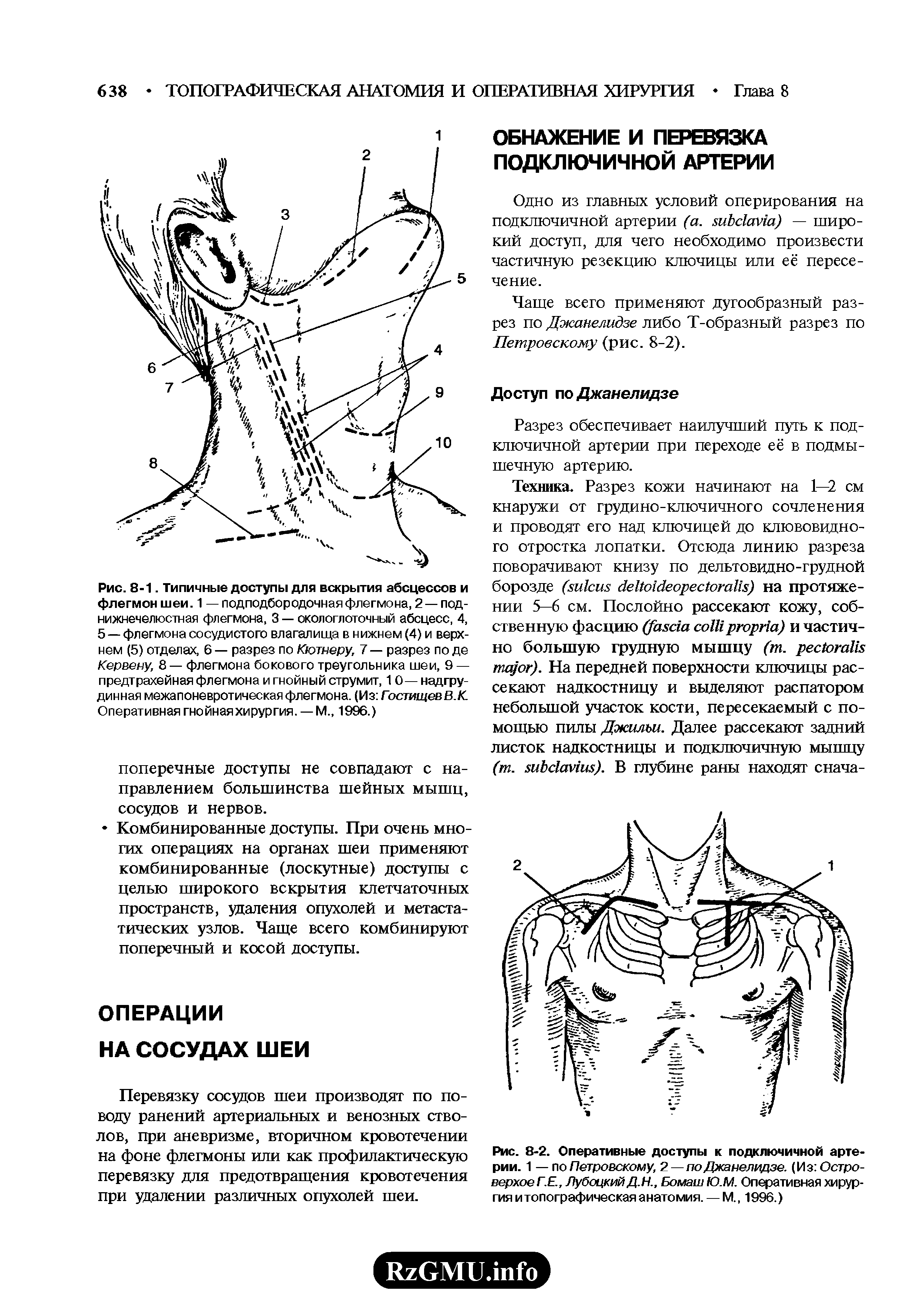 Рис. 8-2. Оперативные доступы к подключичной артерии. 1 — по Петровскому, V — по Джанелидзе. (Из Островерхое Г.Е., Лубоцкий Д.Н., Бомаш Ю.М. Оперативная хирургия и топографическая анатомия. — М., 1996.)...