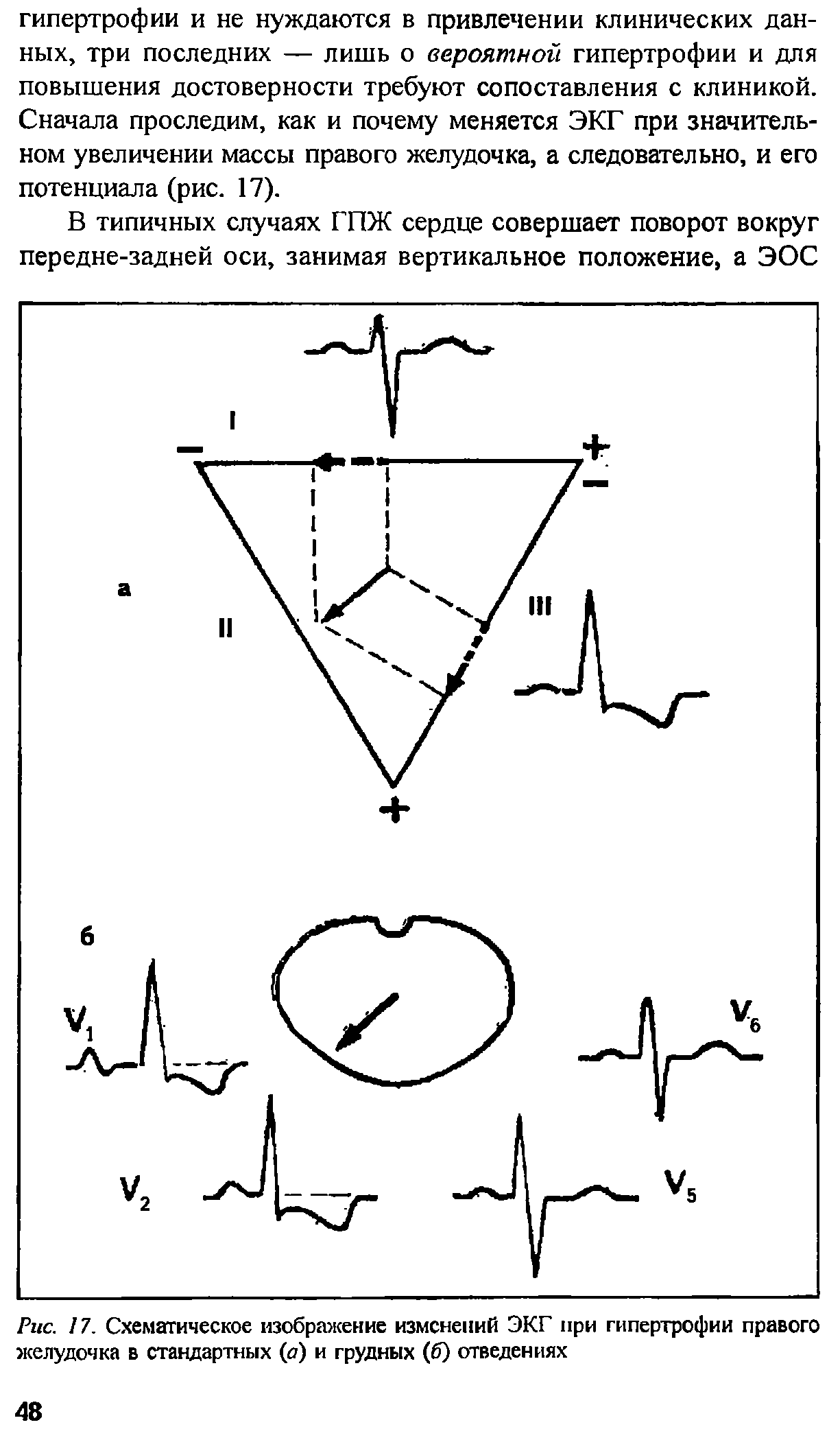 Рис. 17. Схематическое изображение изменений ЭКГ при гипертрофии правого желудочка в стандартных (а) и грудных (6) отведениях...