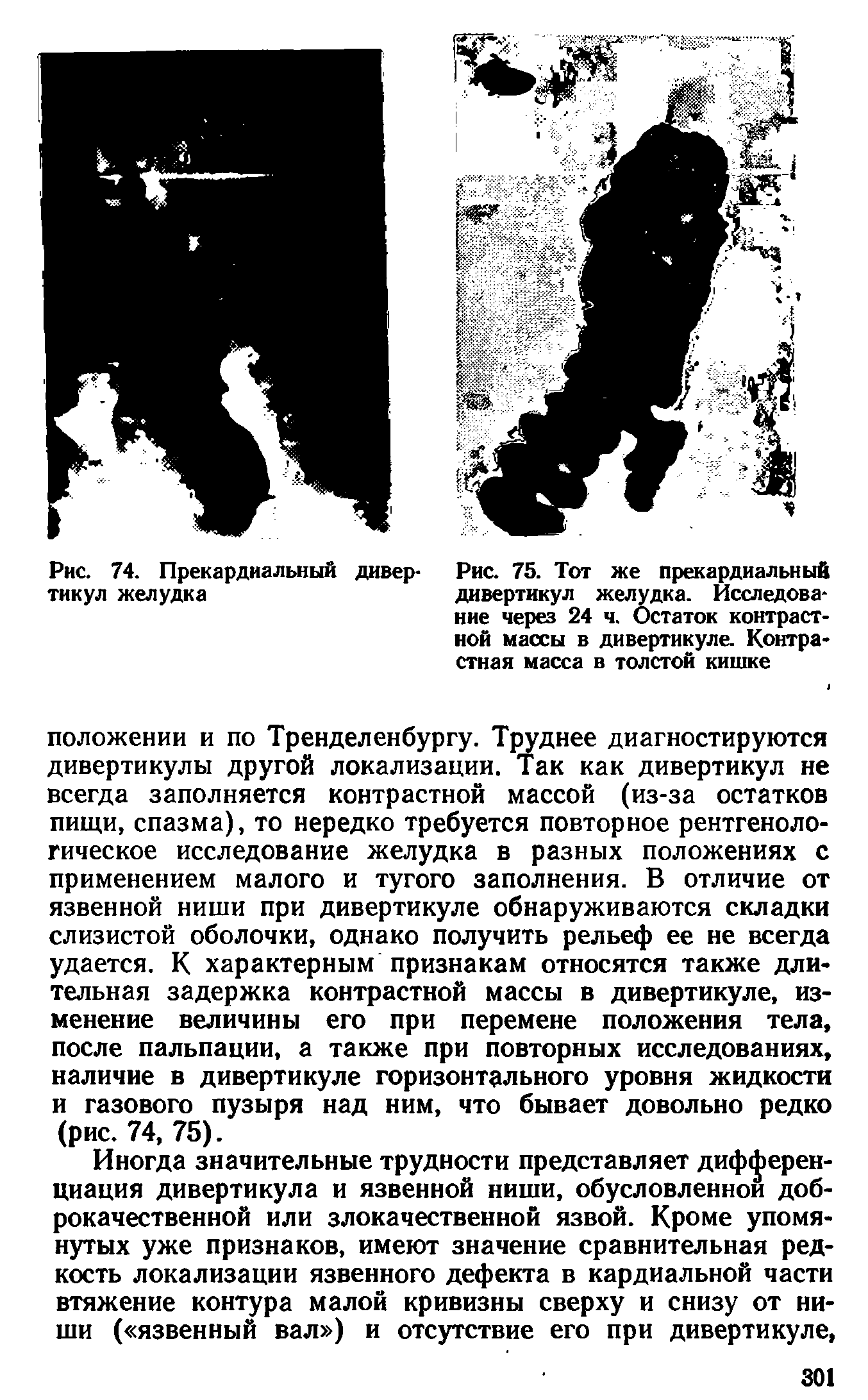 Рис. 75. Тот же прекардиальный дивертикул желудка. Исследование через 24 ч. Остаток контрастной массы в дивертикуле. Контрастная масса в толстой кишке...