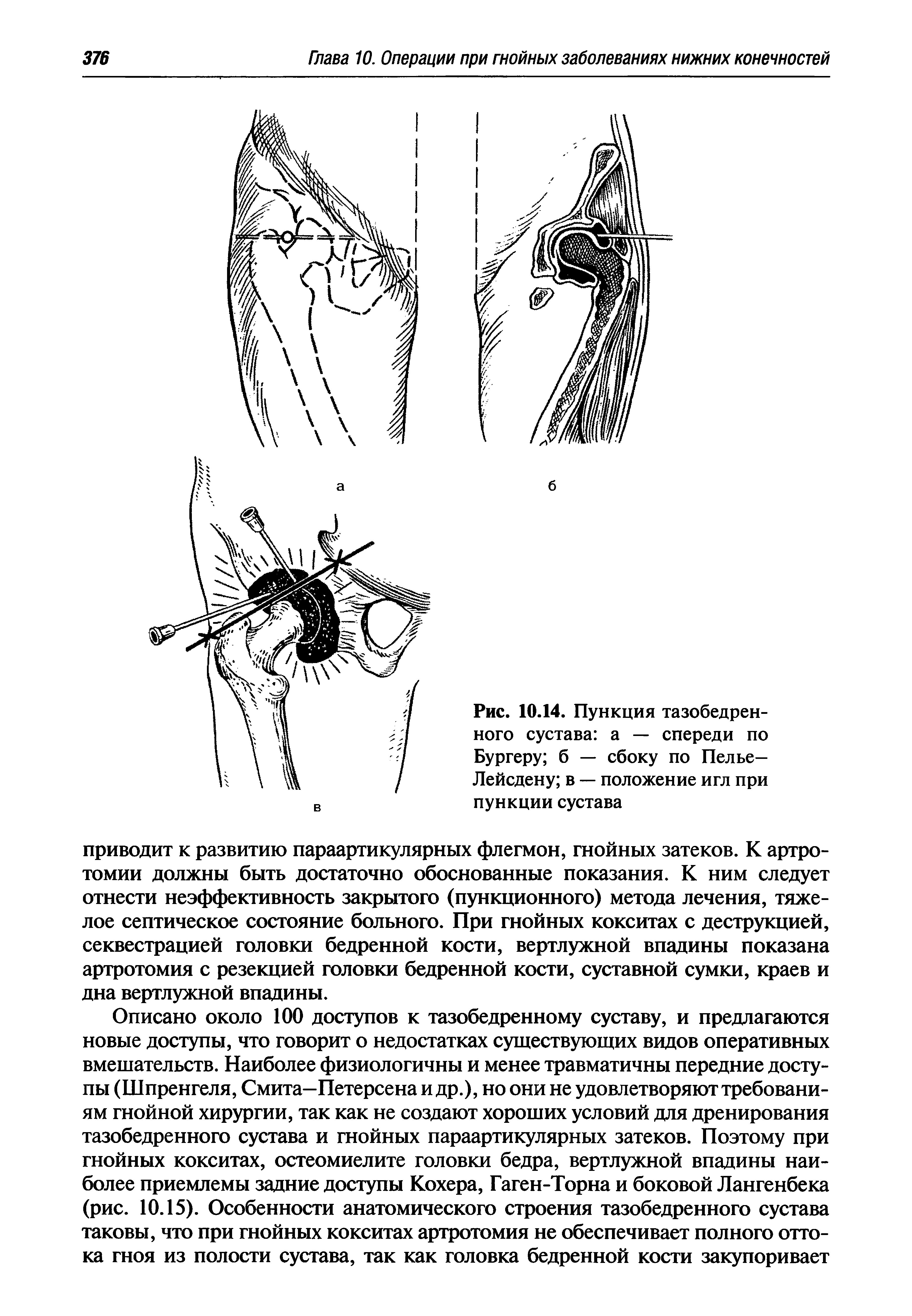Рис. 10.14. Пункция тазобедренного сустава а — спереди по Бургеру б — сбоку по Пелье— Лейсдену в — положение игл при пункции сустава...