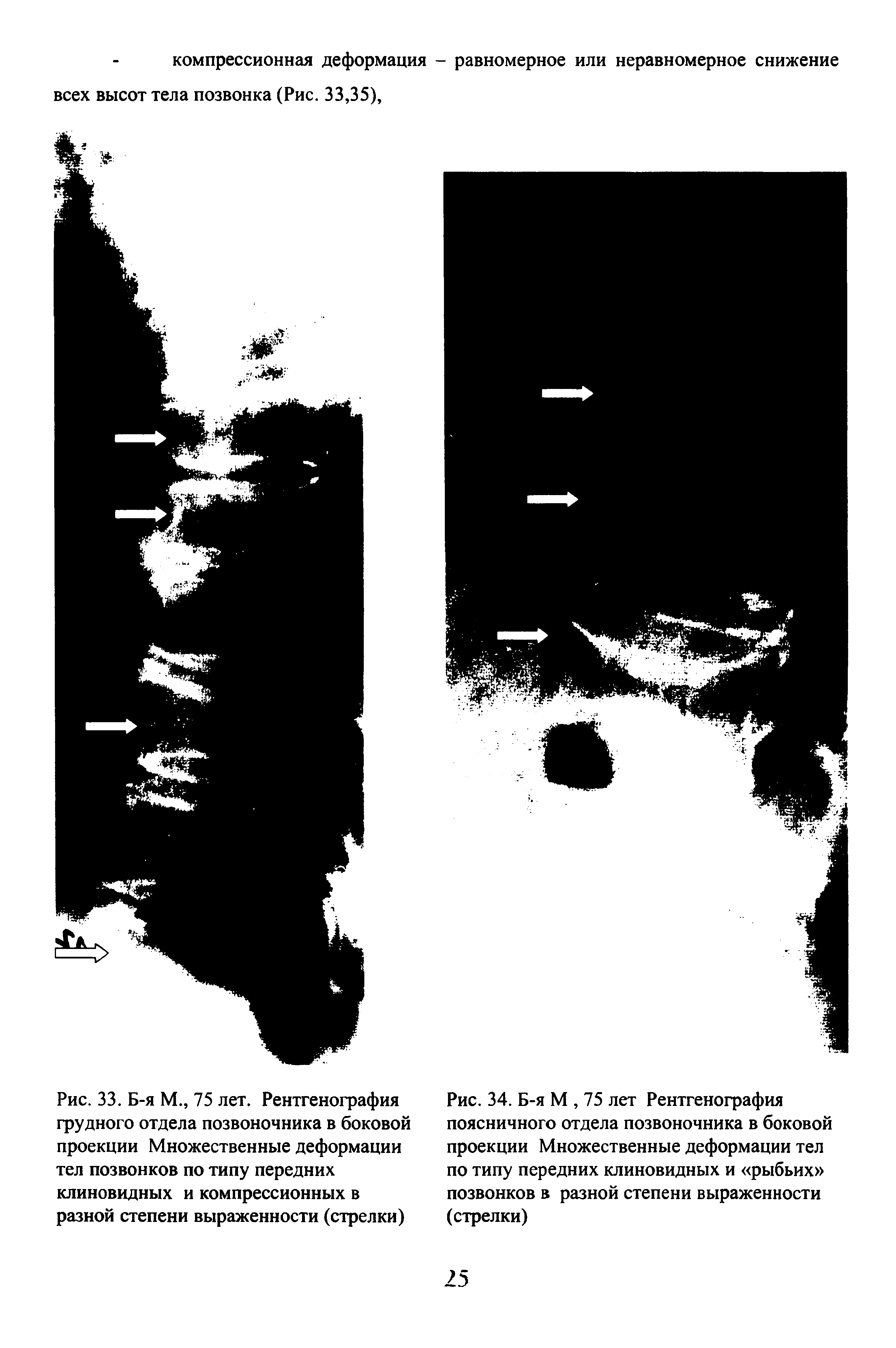 Рис. 33. Б-я М., 75 лет. Рентгенография грудного отдела позвоночника в боковой проекции Множественные деформации тел позвонков по типу передних клиновидных и компрессионных в разной степени выраженности (стрелки)...