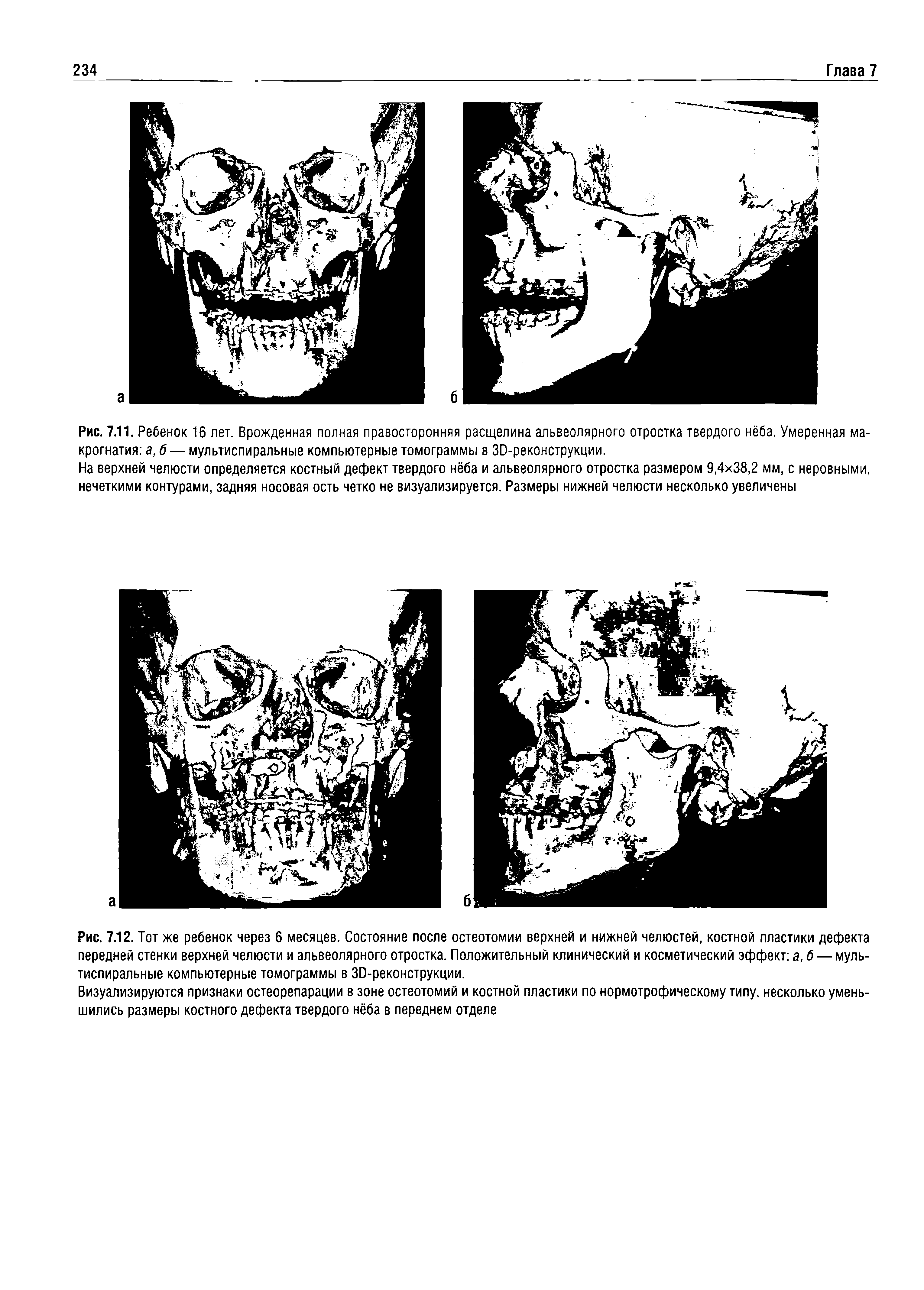 Рис. 7.12. Тот же ребенок через 6 месяцев. Состояние после остеотомии верхней и нижней челюстей, костной пластики дефекта передней стенки верхней челюсти и альвеолярного отростка. Положительный клинический и косметический эффект а, б — мультиспиральные компьютерные томограммы в ЗО-реконструкции.