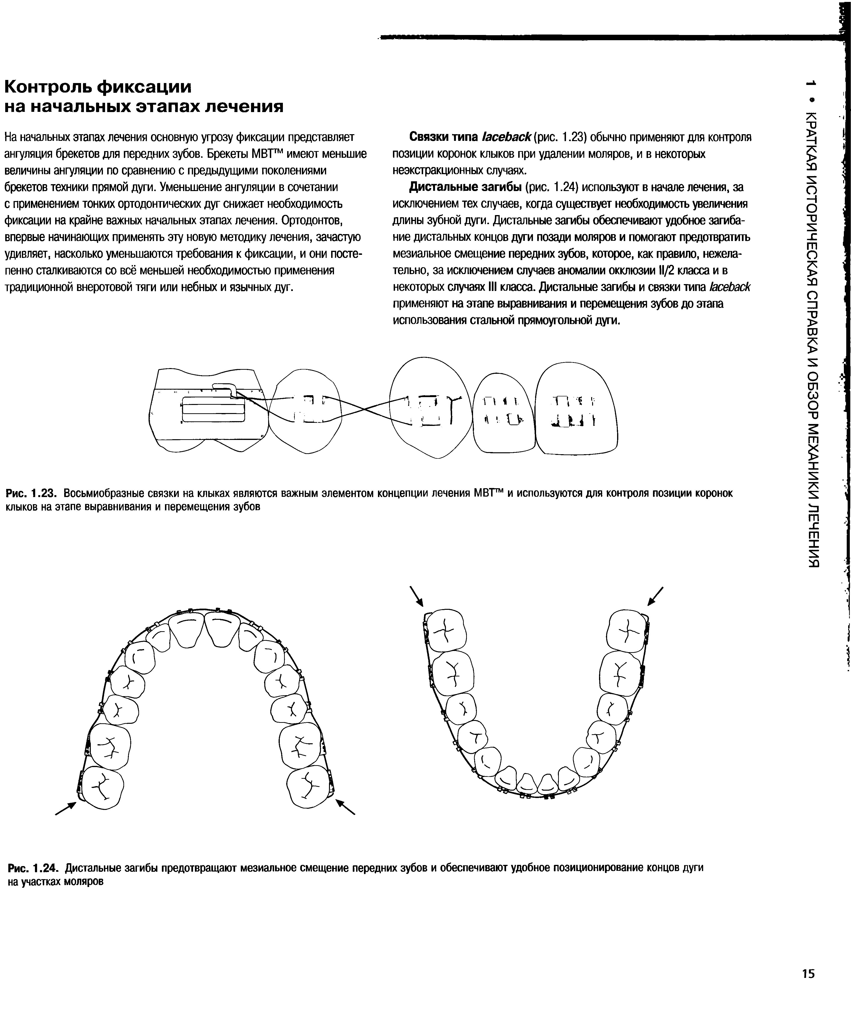 Рис. 1.23. Восьмиобразные связки на клыках являются важным элементом концепции лечения МВТ и используются для контроля позиции коронок клыков на этапе выравнивания и перемещения зубов...