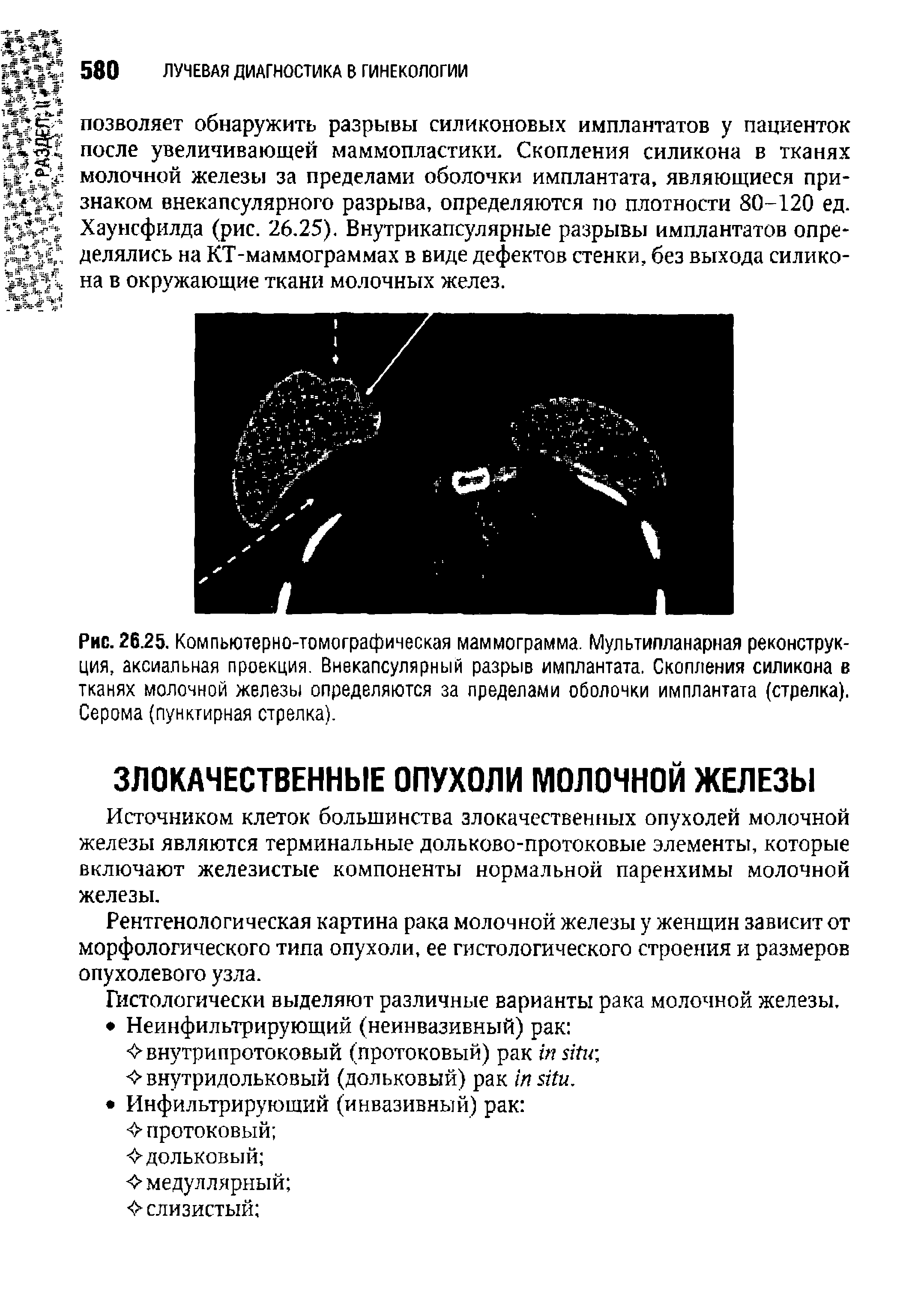 Рис. 26.25. Компьютерно-томографическая маммограмма. Мультипланарная реконструкция, аксиальная проекция. Внекапсулярный разрыв имплантата. Скопления силикона в тканях молочной железы определяются за пределами оболочки имплантата (стрелка). Серома (пунктирная стрелка).