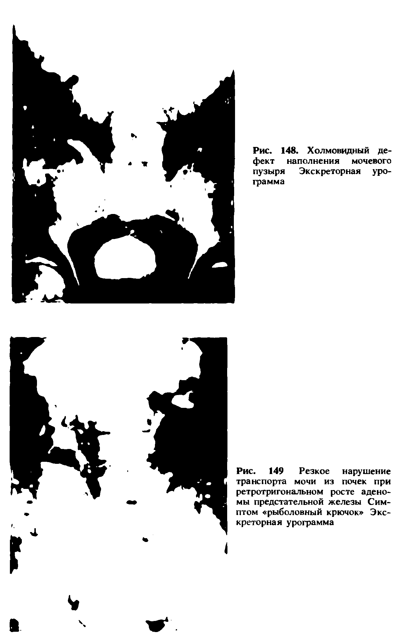 Рис. 149 Резкое нарушение транспорта мочи из почек при ретротригональном росте аденомы предстательной железы Симптом рыболовный крючок Экскреторная урограмма...